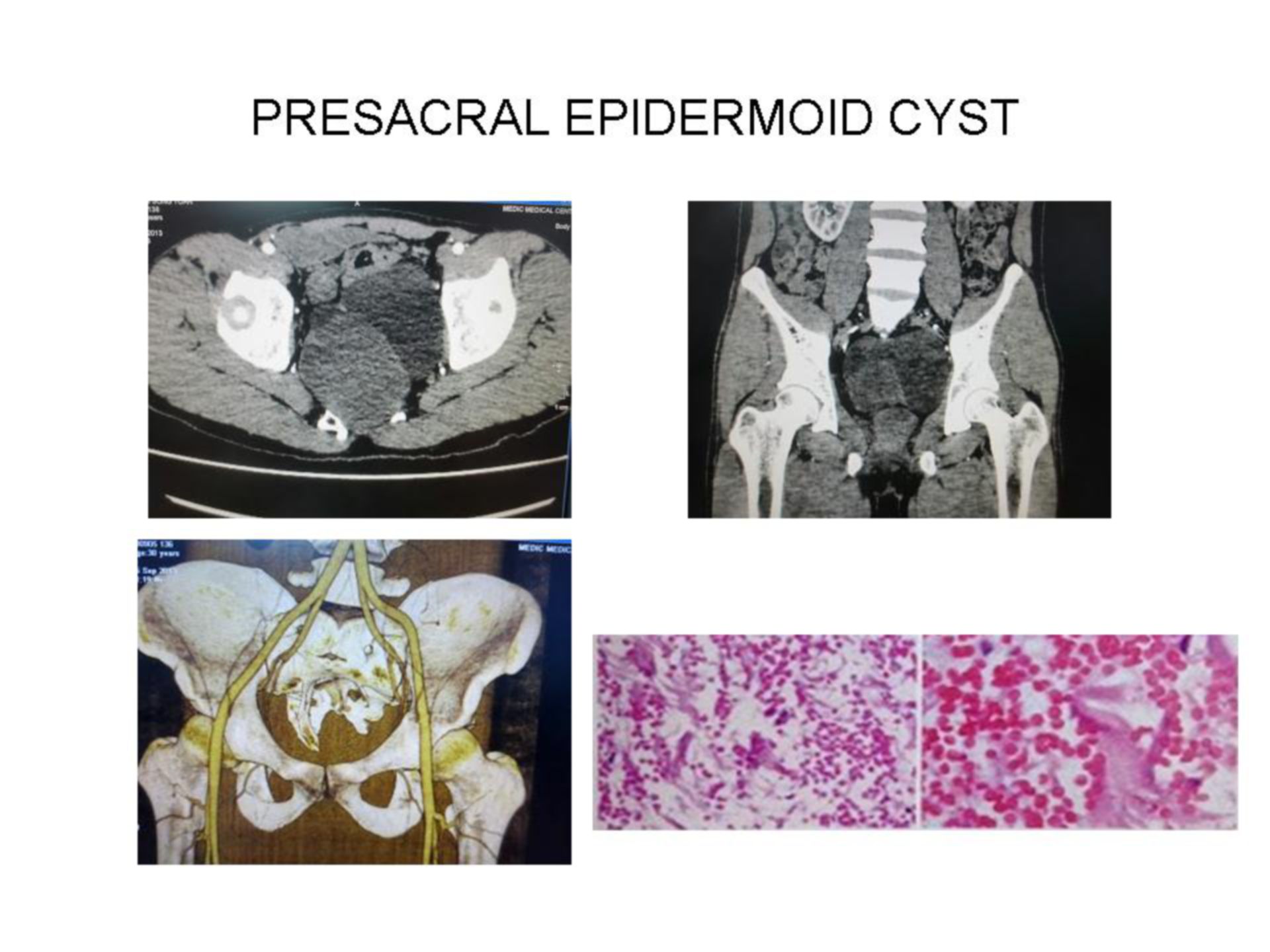 Epidermoidzyste