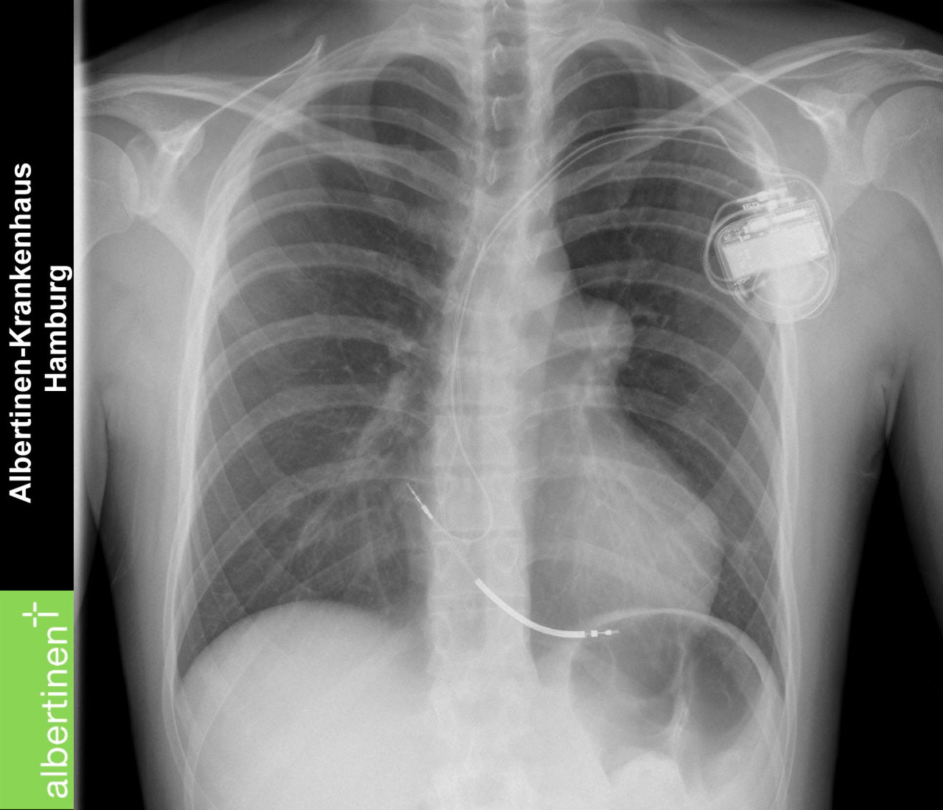 A-ICD-pacemaker (X-ray)