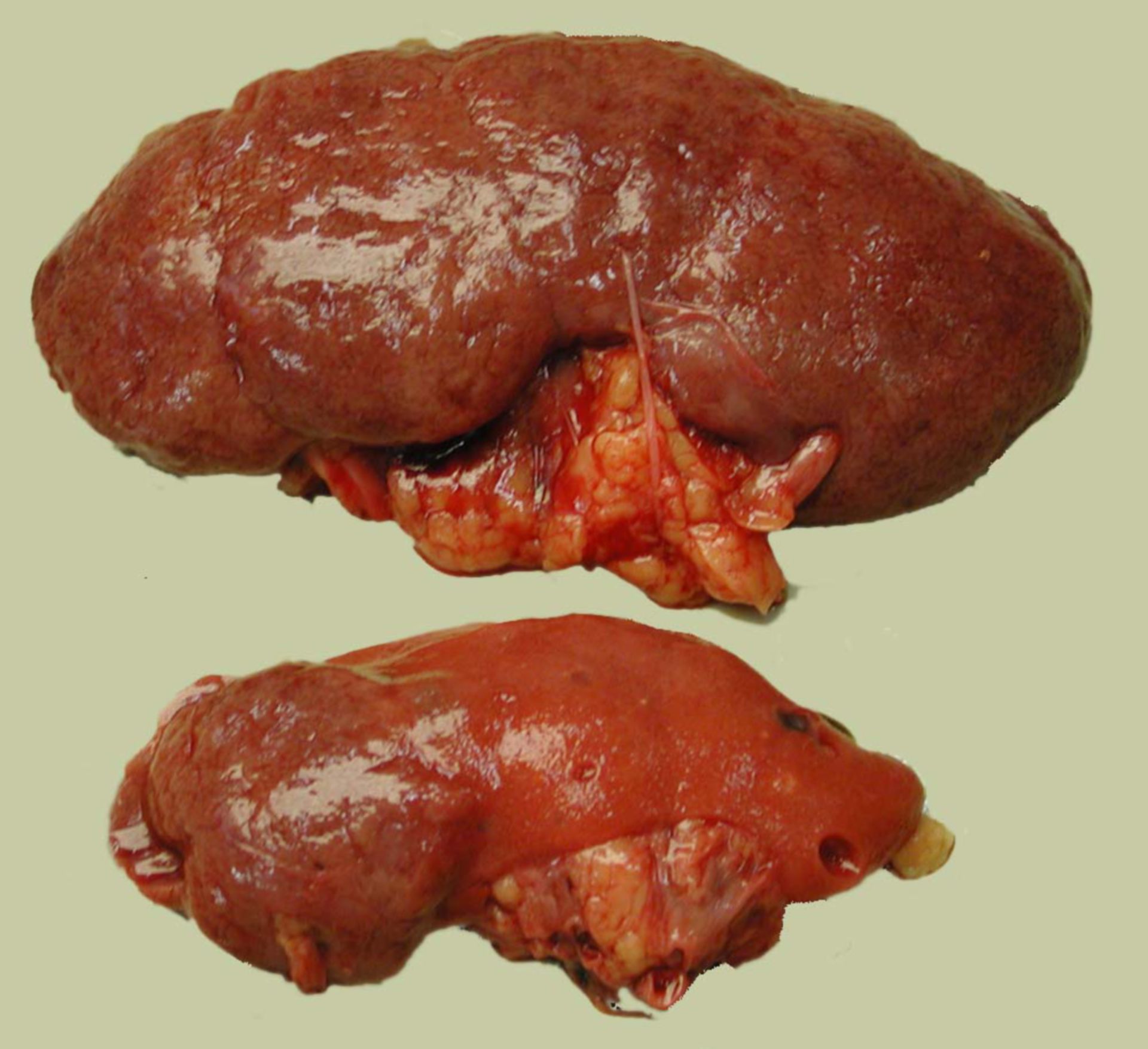 Subinfarct of kidney (2)