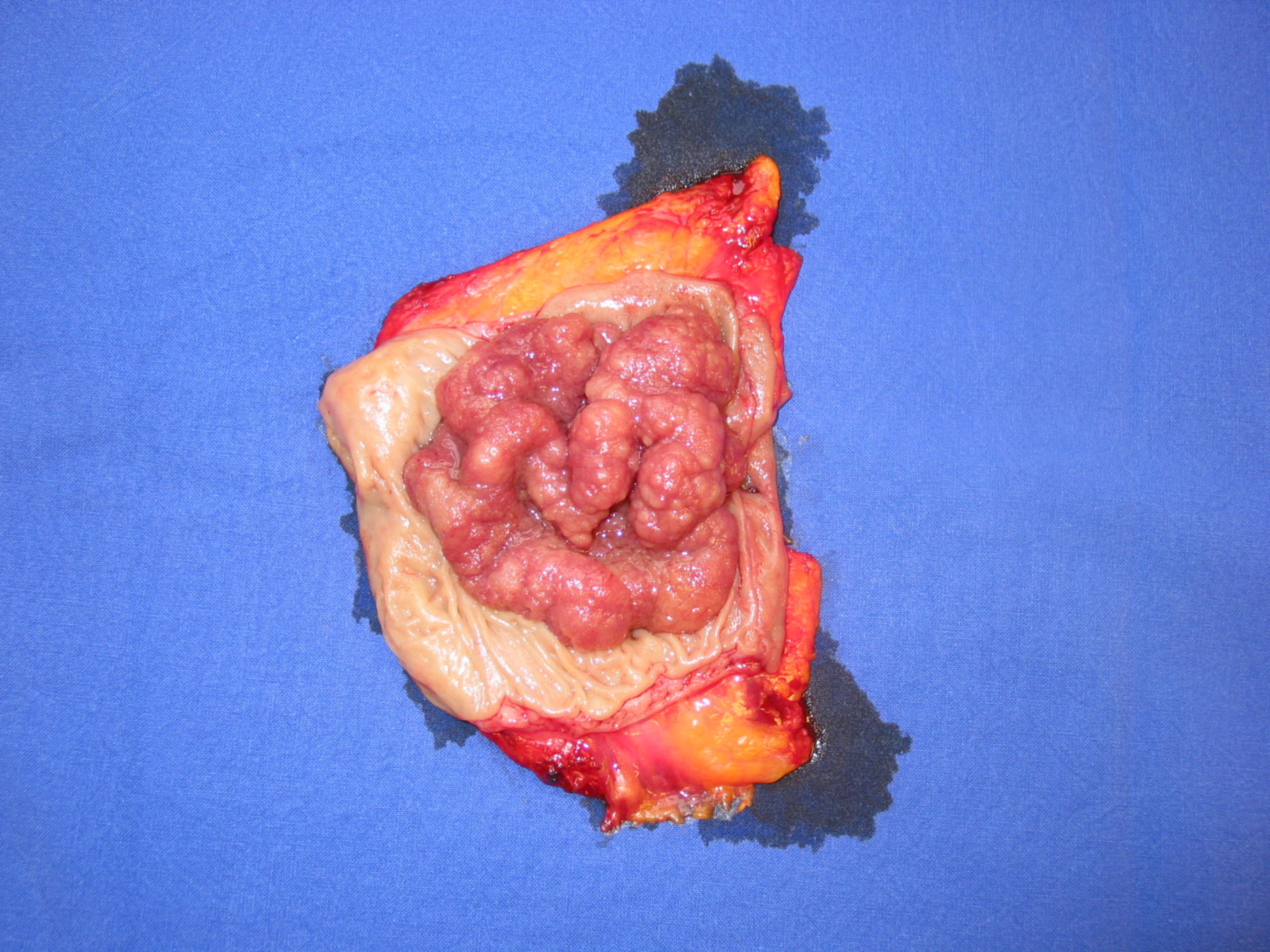Large adenoma of the rectum
