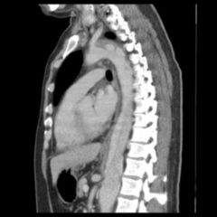 Aortendissektion Doccheck Flexikon