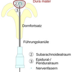 Periduralanästhesie DocCheck Flexikon
