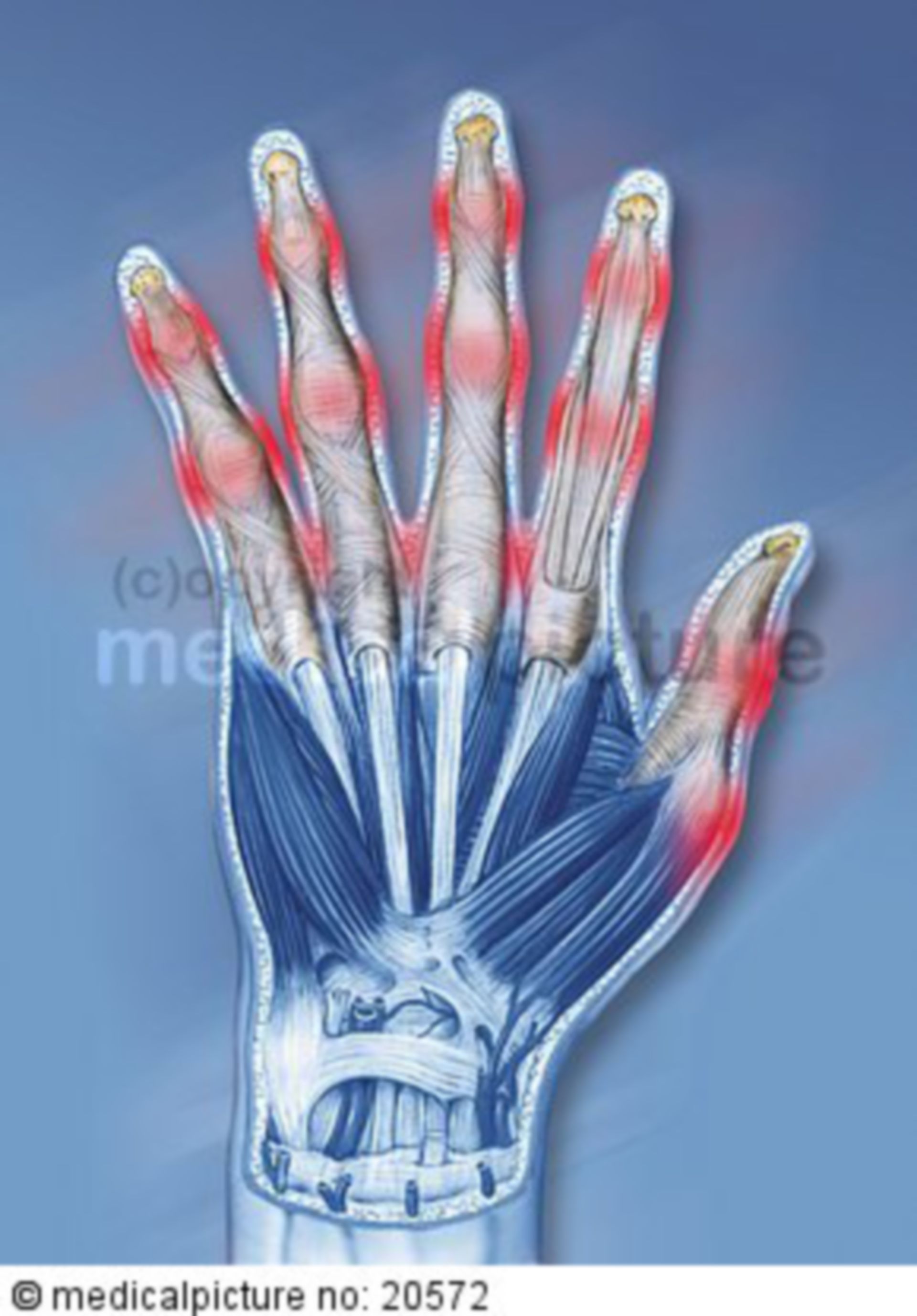  Menschliche Hand mit arthritischen Prädilektionsstellen 