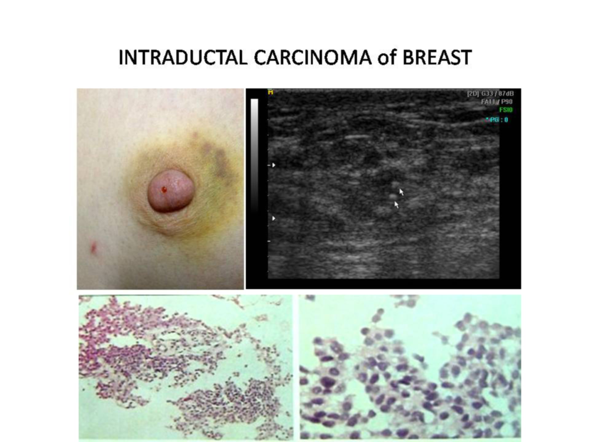 INTRADUCTAL CARCINOMA of BREAST