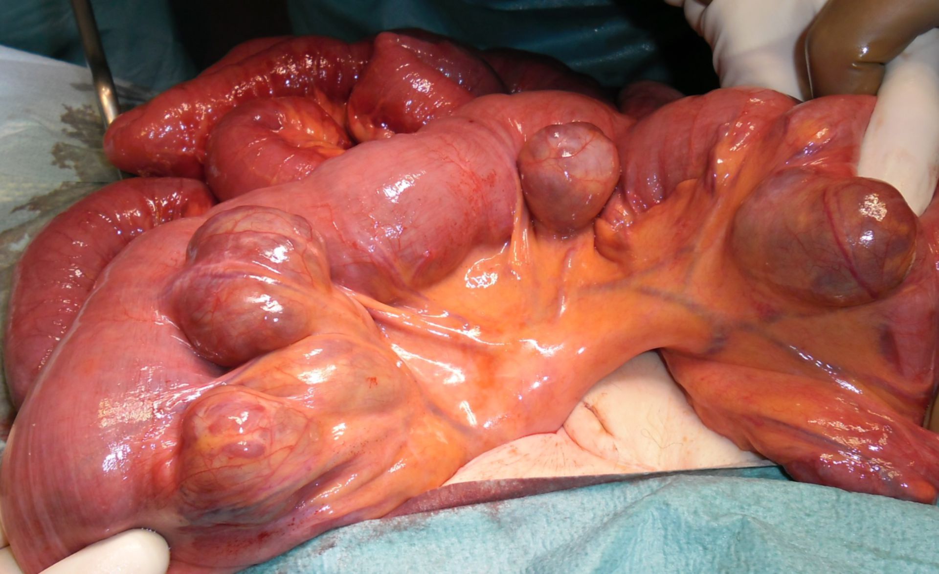 Diverticulosis of the small intestine