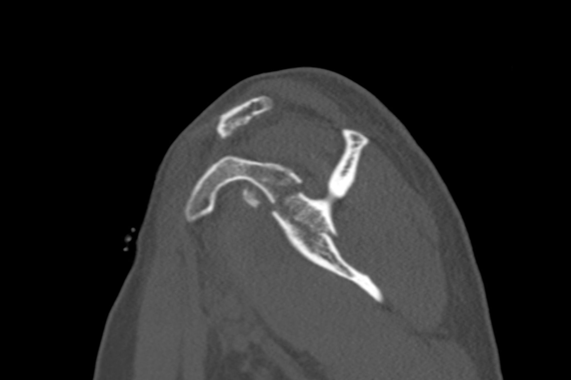 CT der Schulter mit Darstellung einer mehrfragmentären Skapluafraktur