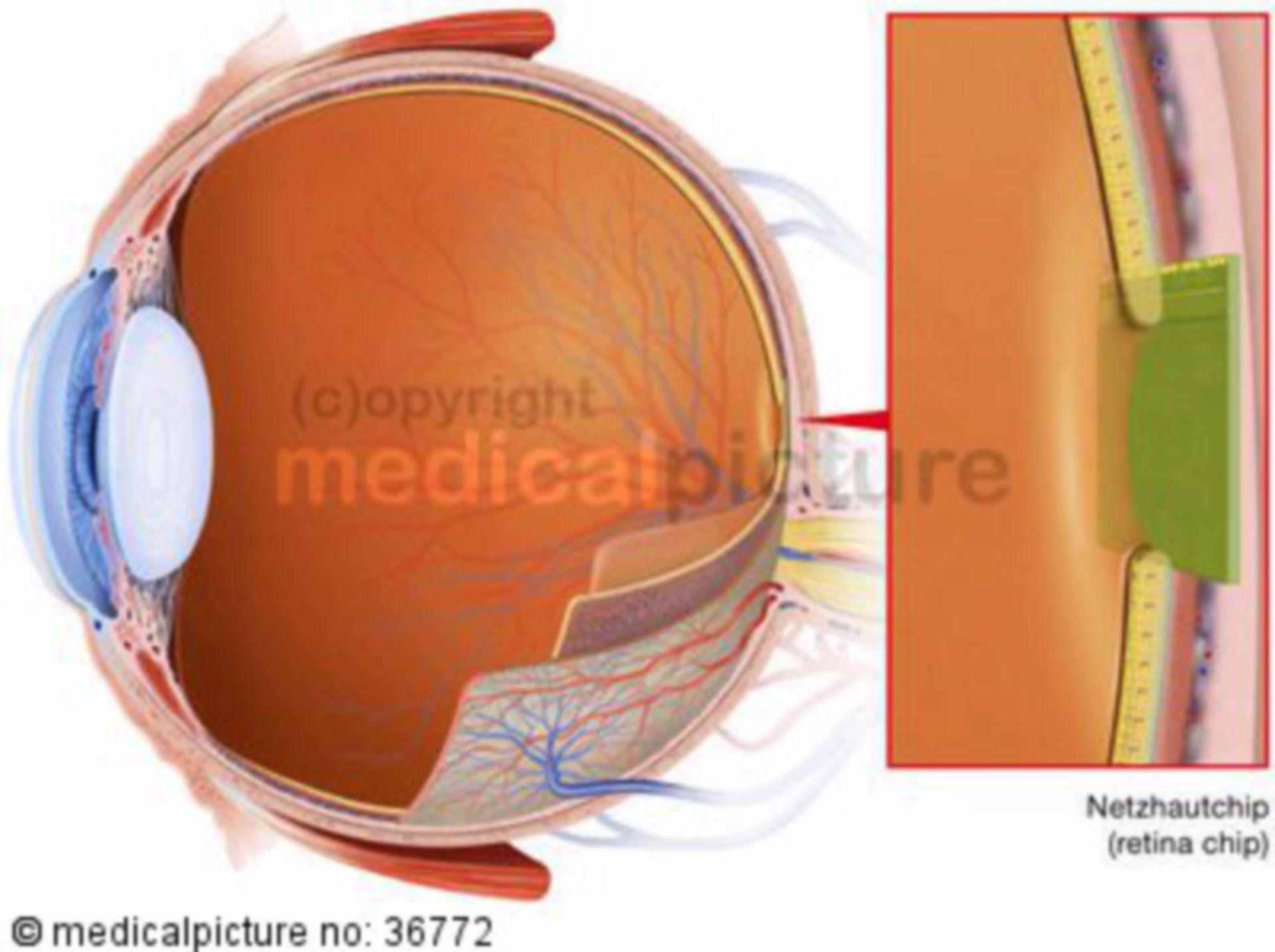  Modell eines Retinaimplantats 
