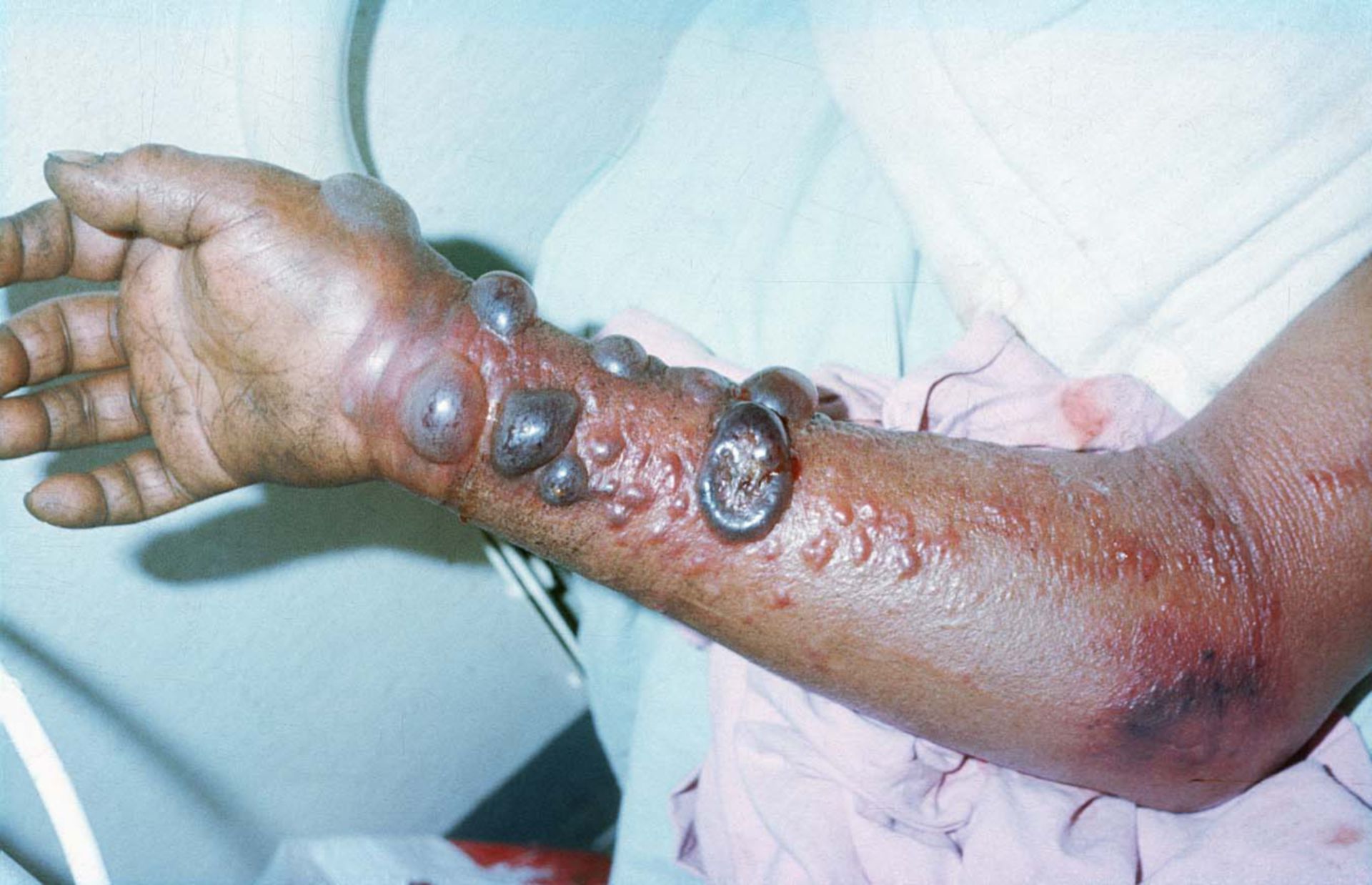 Hemorrhagic fever Ebola Ethiopia