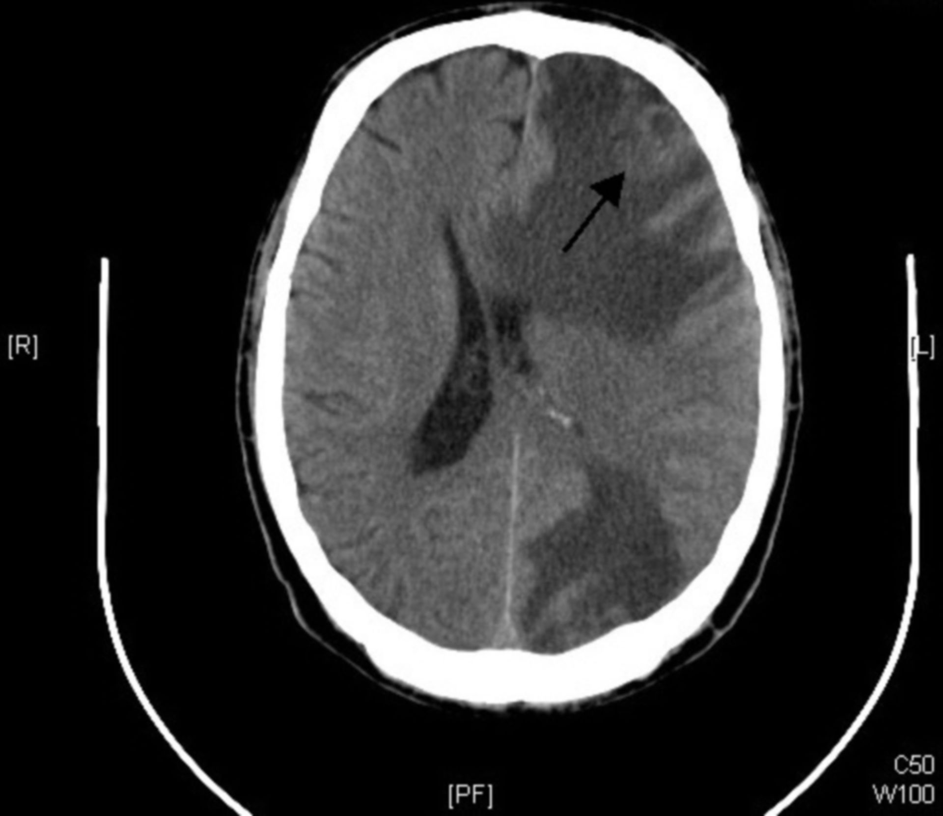 CT-Scan des Gehirns - Metastasierendes Lungenadenokarzinom