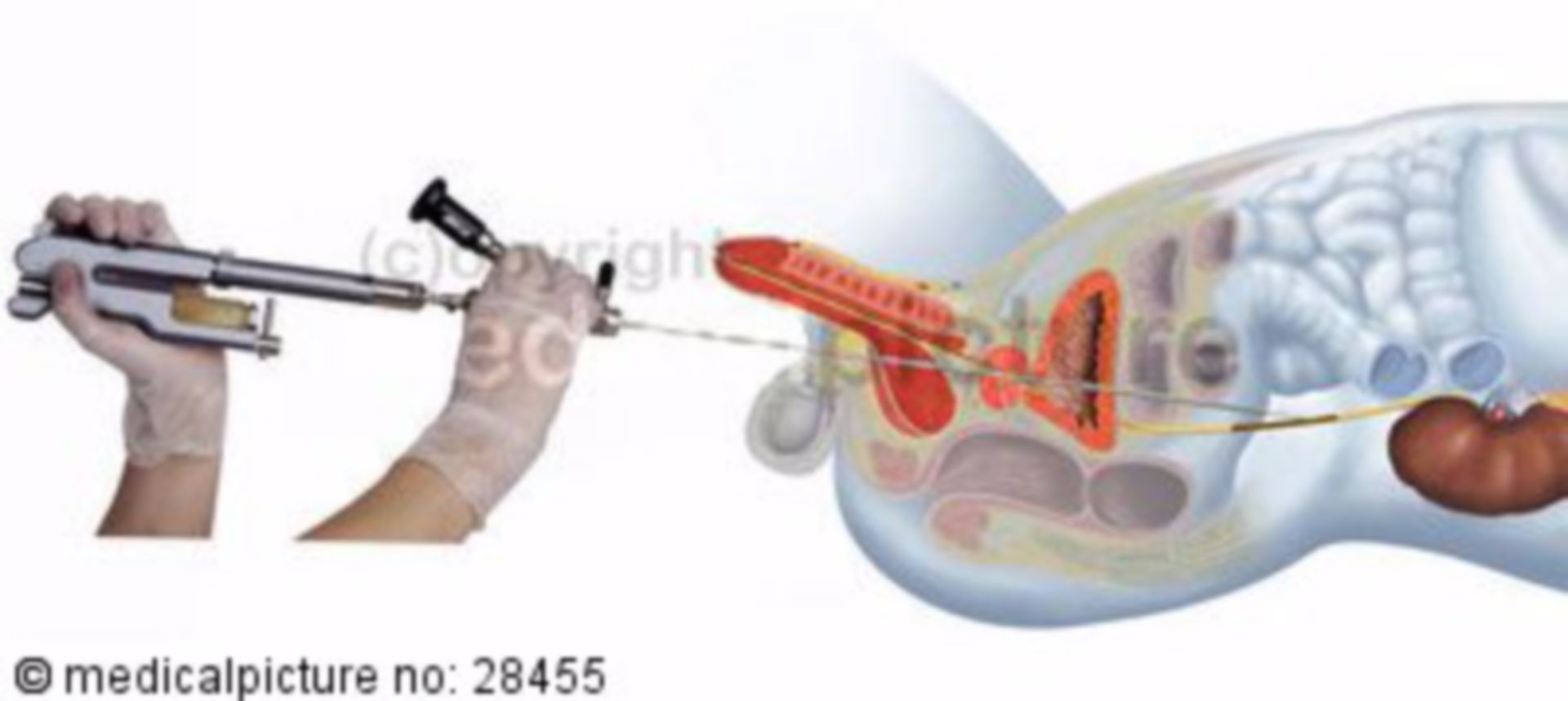 Vorbereitung einer transurethralen Harnleitersteinentfernung, männlicher Unterkörper