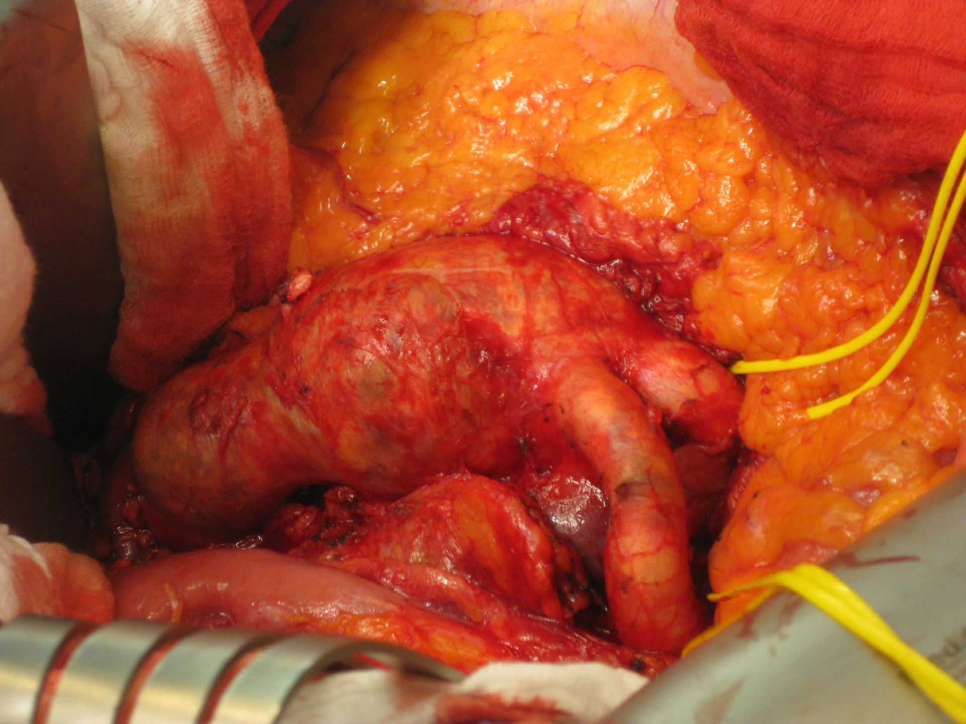 Aneurysm of abdominal aorta (infrarenal)