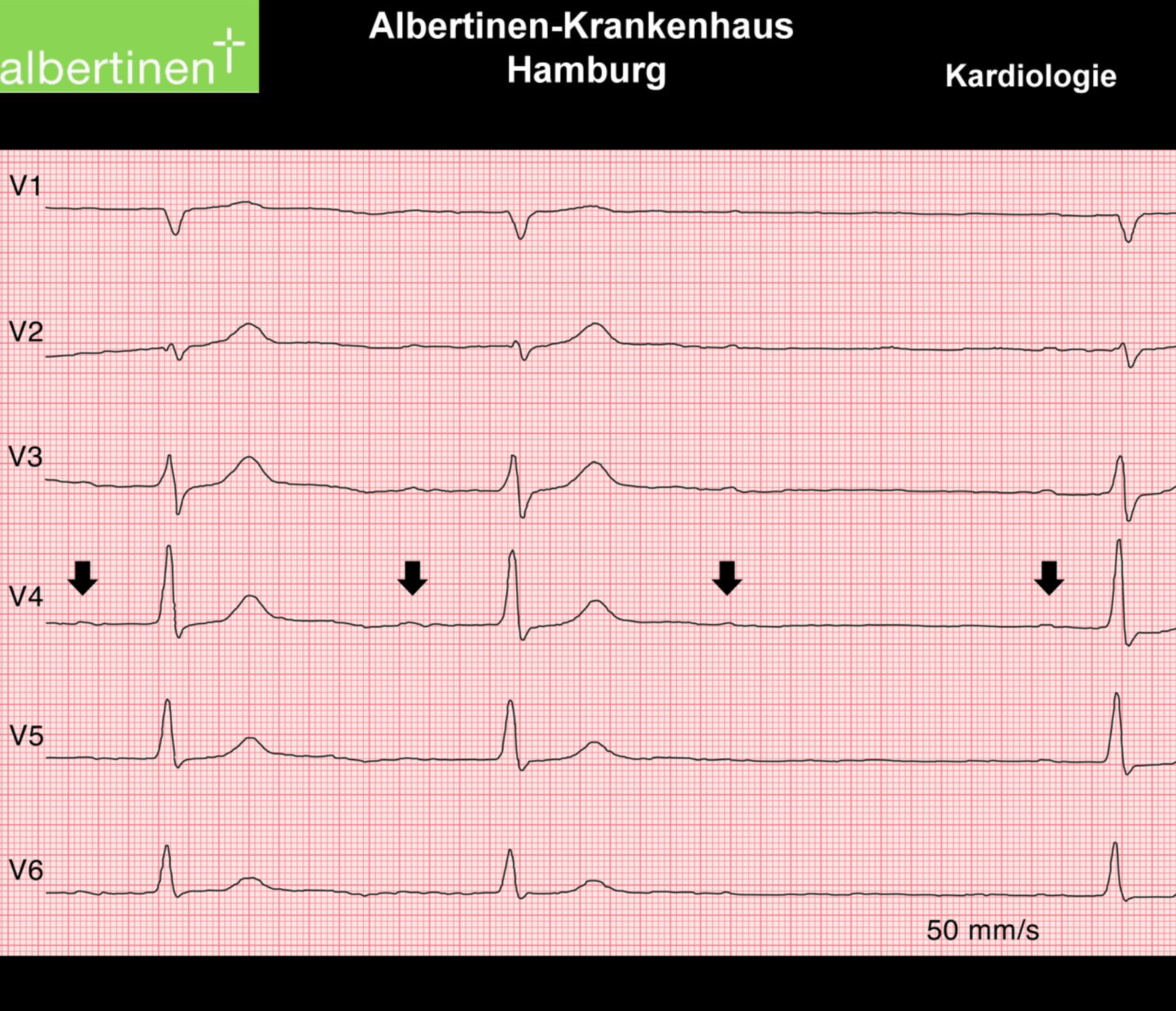 ECG: Second degree atrioventricular block -  Mobitz type I/ Wenckebach