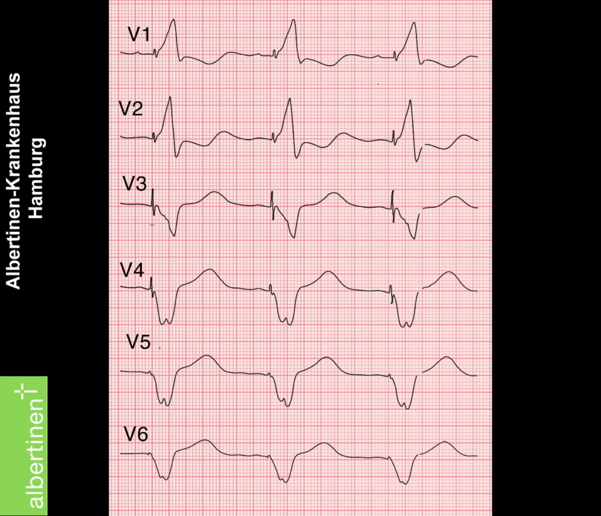 Triggered ventricle stimulation (ECG)