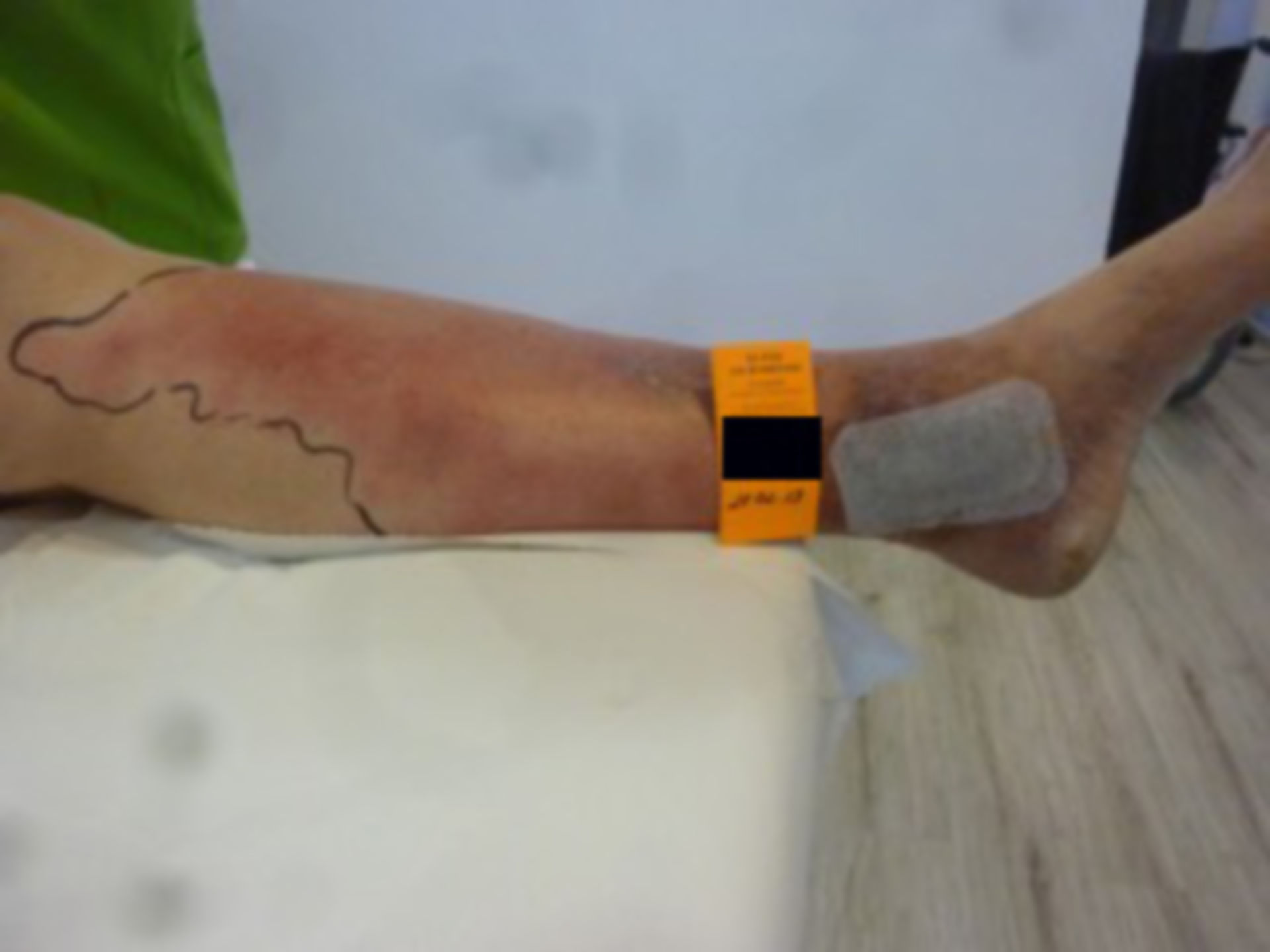Erysipelas and ulcers (two years open)