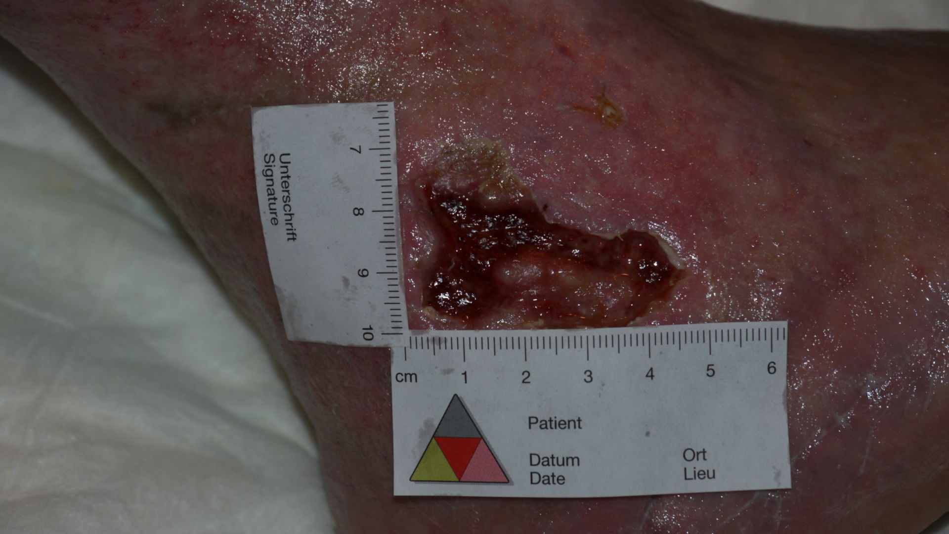 Ulcer on the ankle