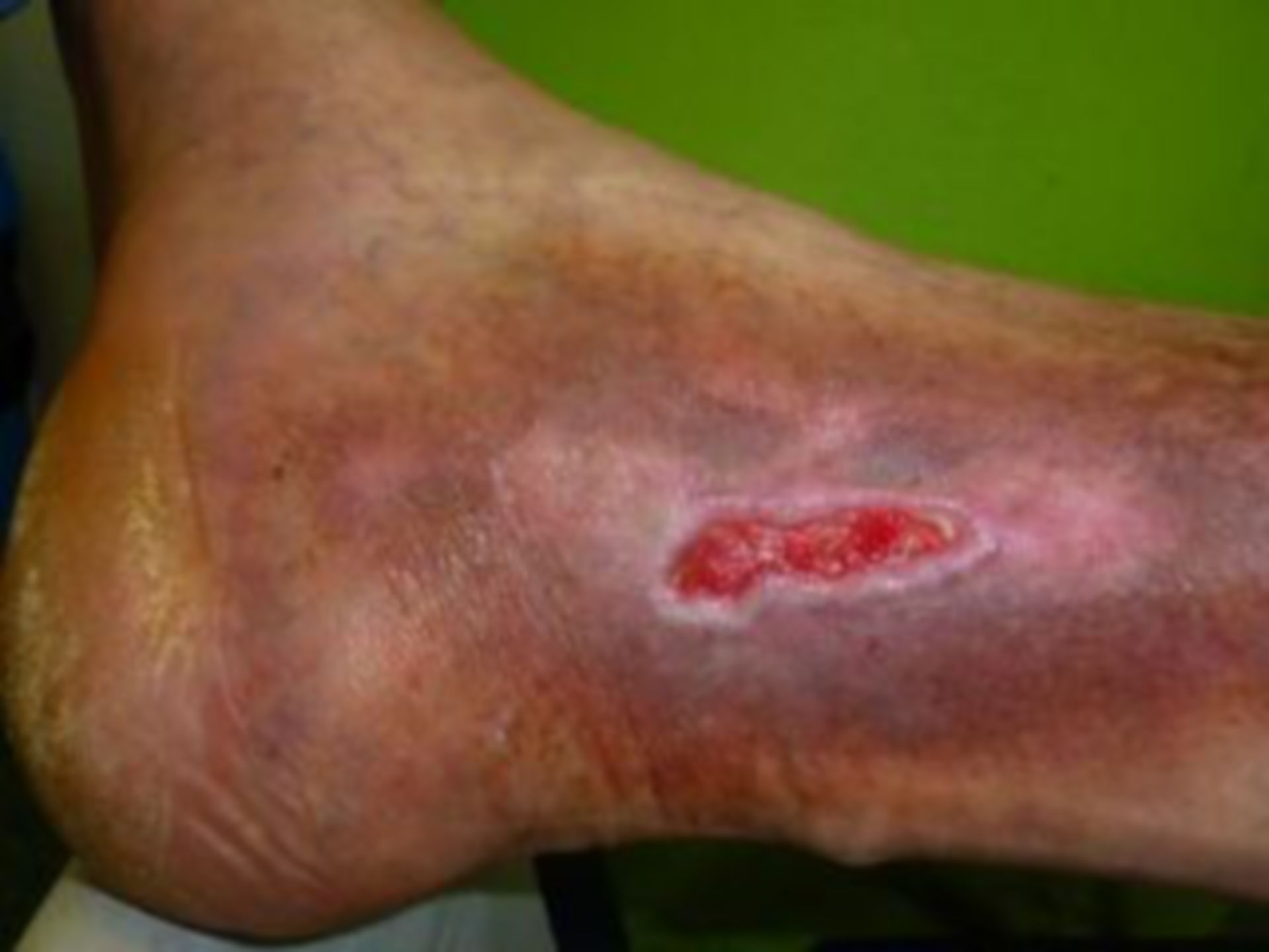 (14) wound care: thrombosis, ulcers of the lower leg  - 2014/08/04 (day of discharge)