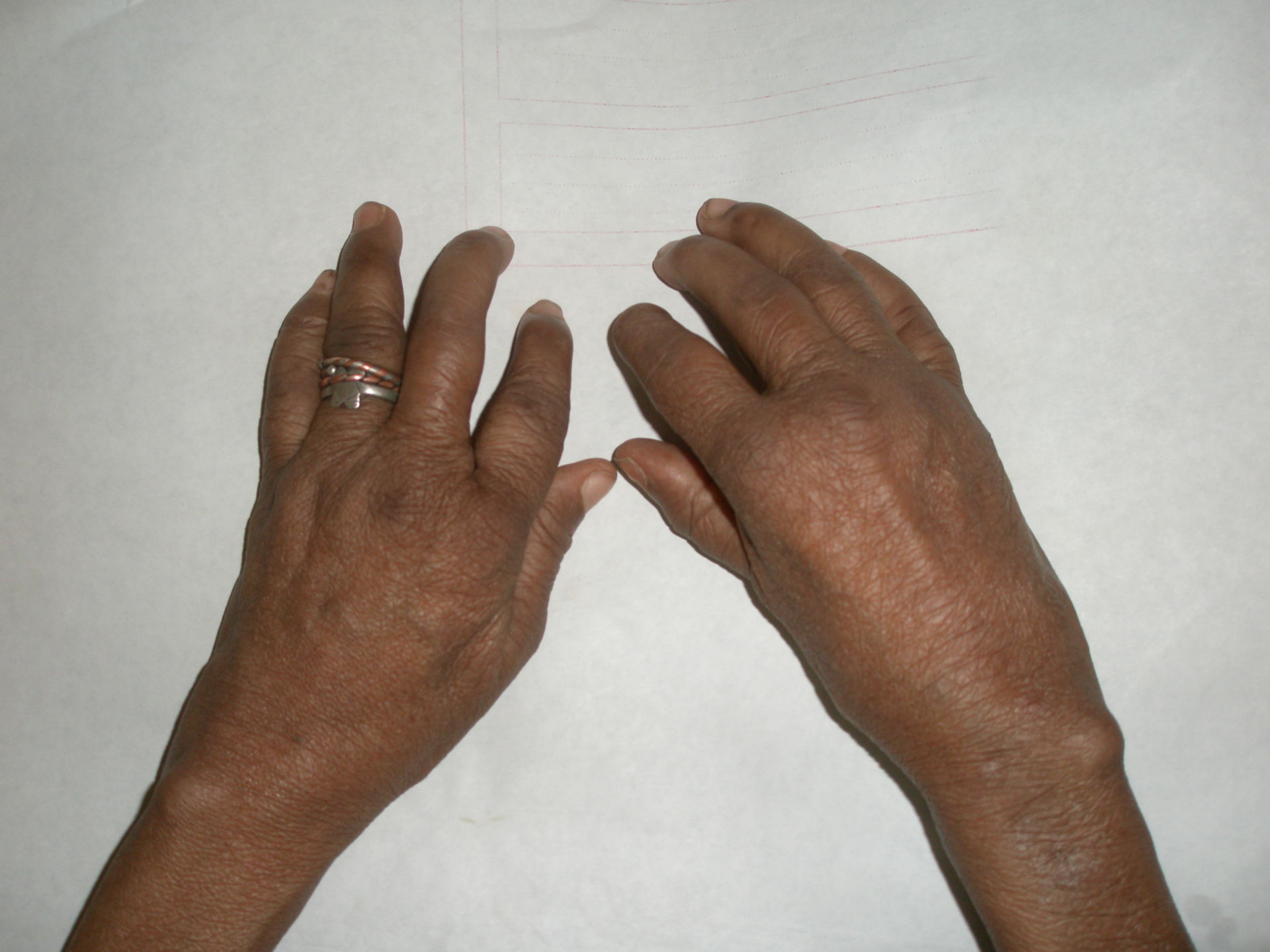 Rheumatoid arthritis, Hand deformity