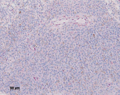 Im rechten Bild ist keine Färbung der Zellen zu erkennen. Nur von den Tumorzellen im rechten Bild geht ein sehr hohes Risiko aus, dass sich die Zellen im Körper ausbreiten. ©Arbeitsgruppe Dr. M. Zeschnigk
