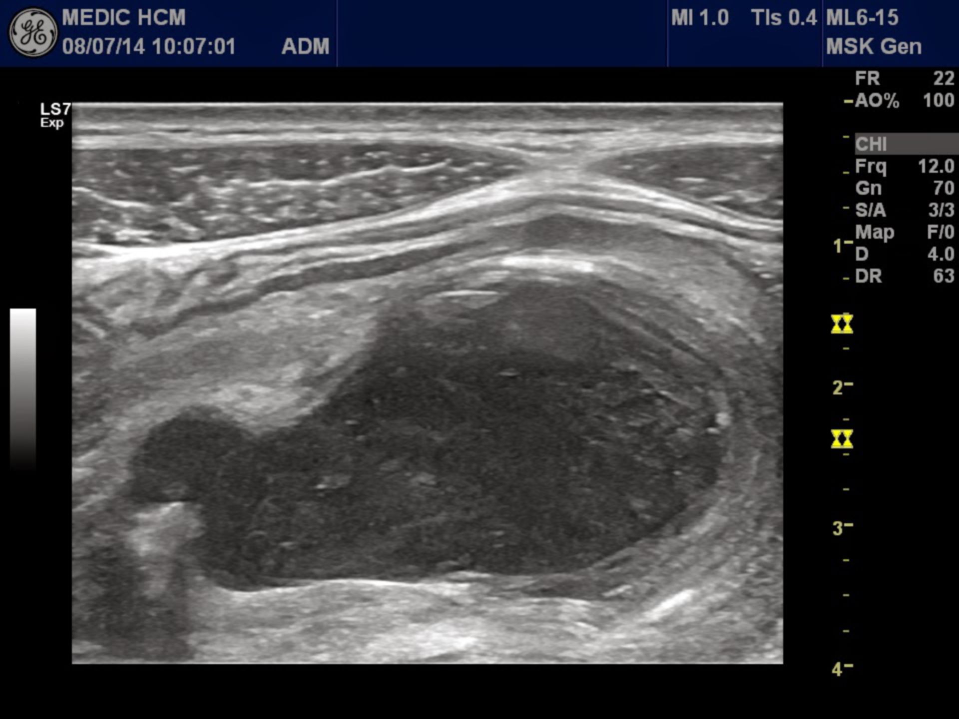 Mukozele der Appendix vermiformis (1)