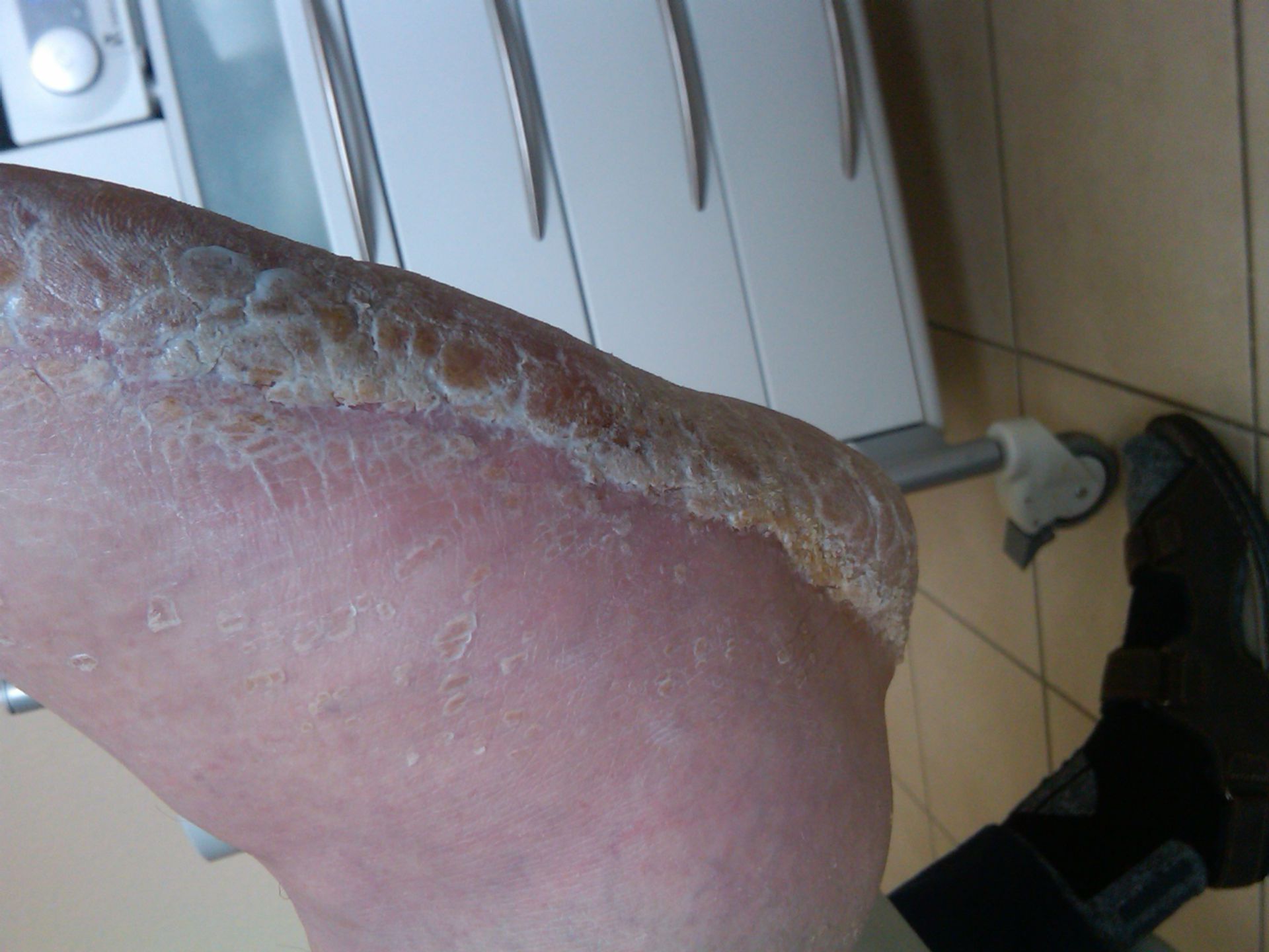 Plantar hyperkeratosis