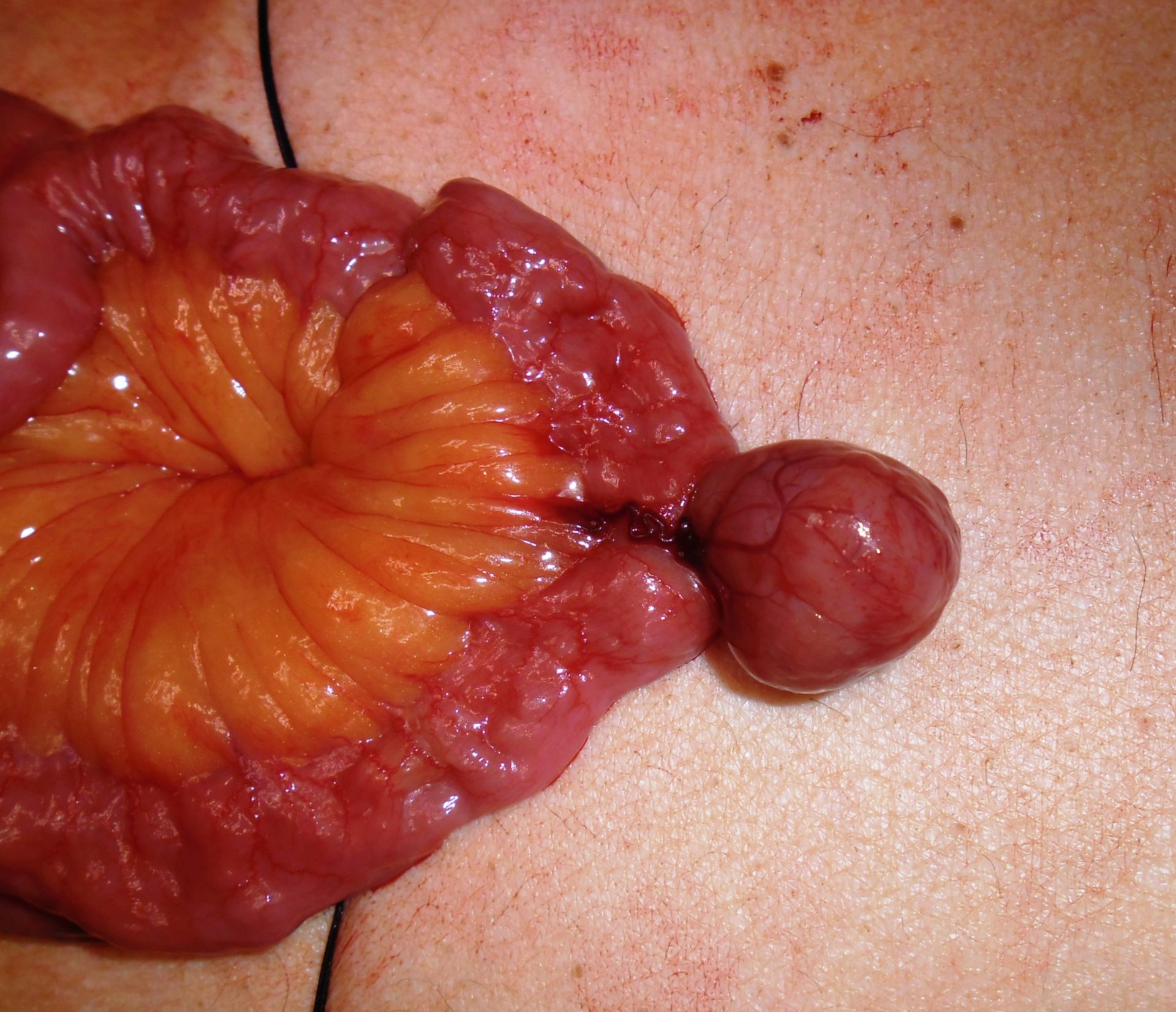 Tumore gastrointestinale stromale (GIST)