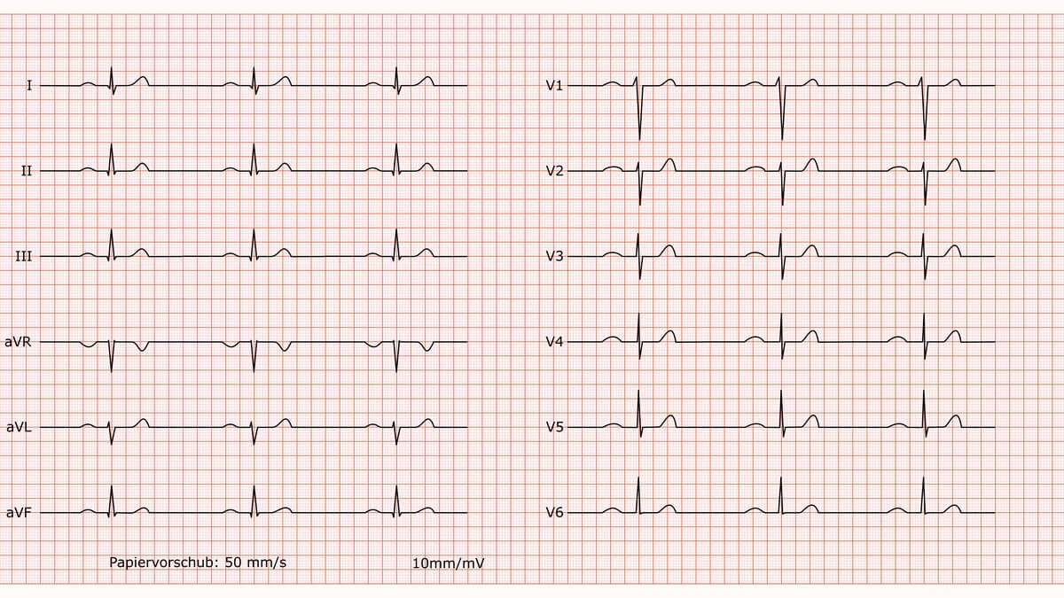 12-Kanal-EKG eines normofrequenten Sinusrhythmus
