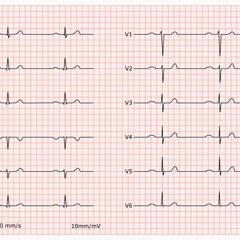 sinusrhythmus-doccheck-flexikon