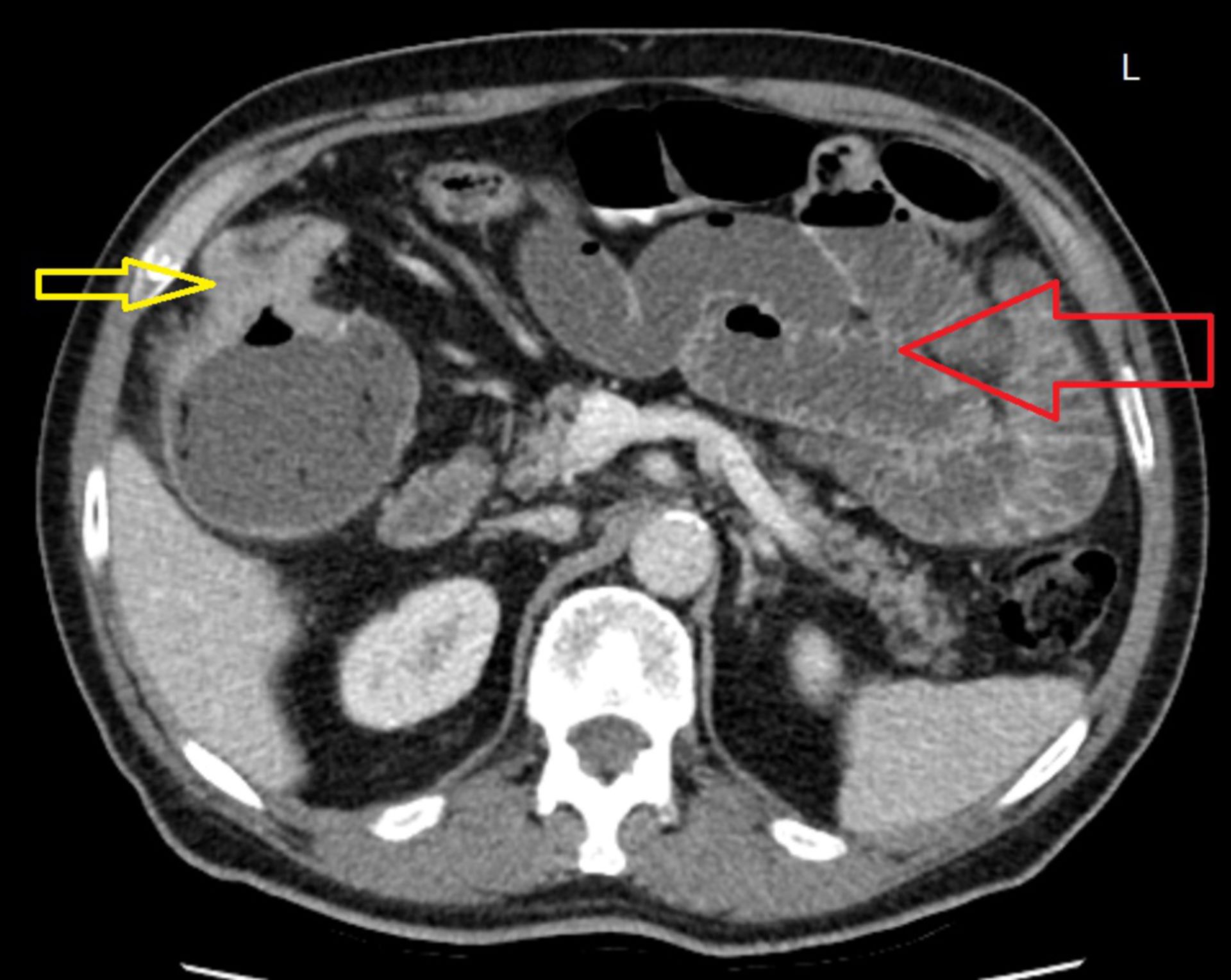 tra1: CT Abdomen in transversaler Ebene