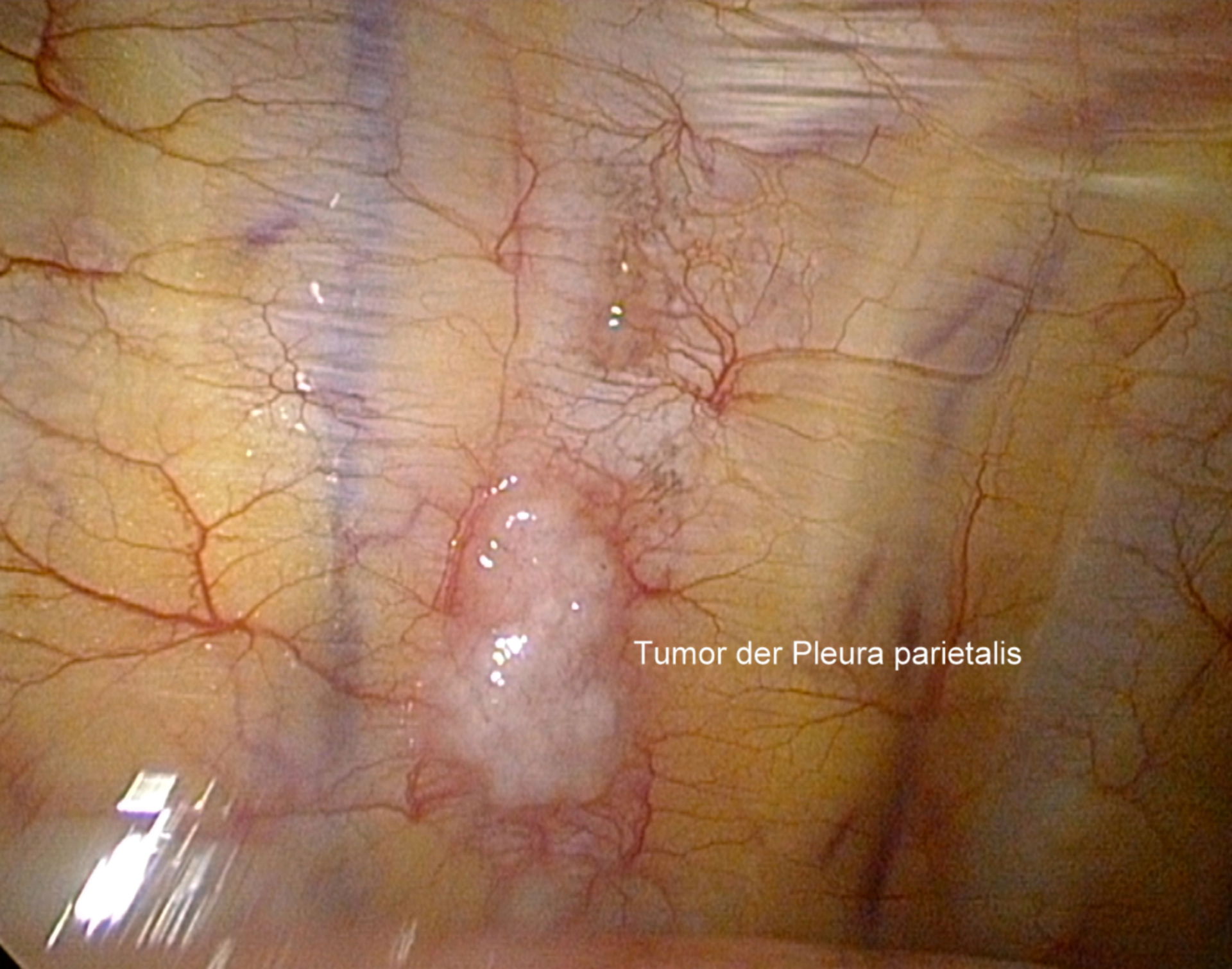 Thorakoskopie-Tumor der Pleura parietalis