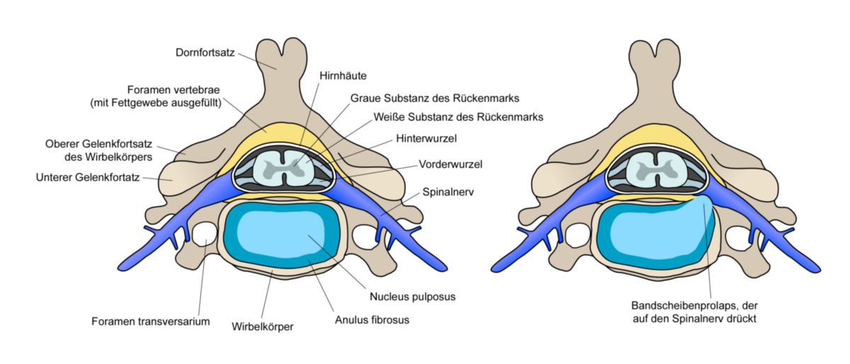 Schnitt durch die Strukturen der Wirbelsäule (links), Bandscheibenvorfall (rechts)