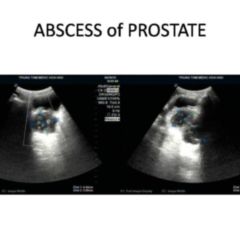prostatitis doccheck)