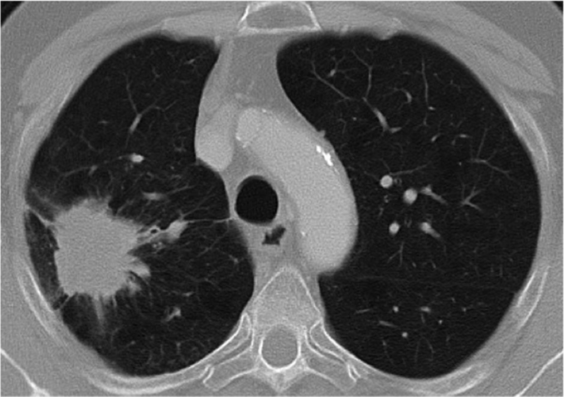 Computer tomography of the thorax (lung carcinoma)