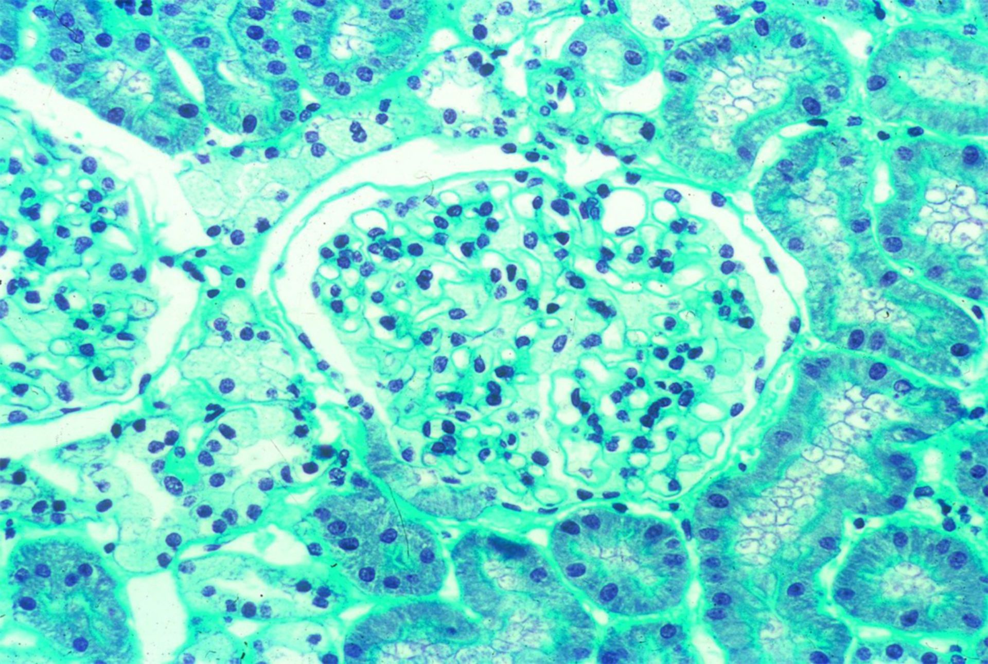 Niere bei Morbus Fabry (Histologie)
