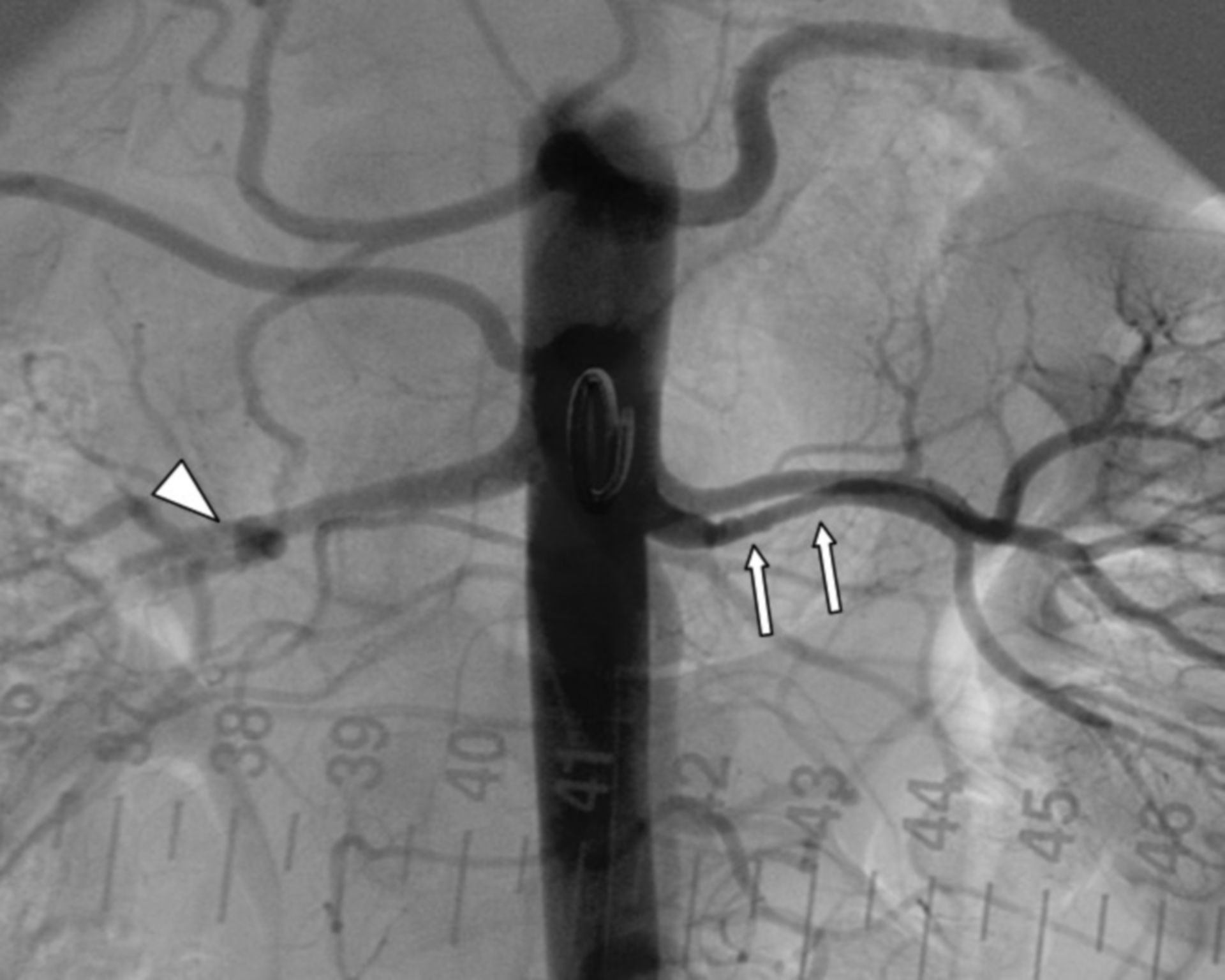 Angiography of a renal artery stenosis