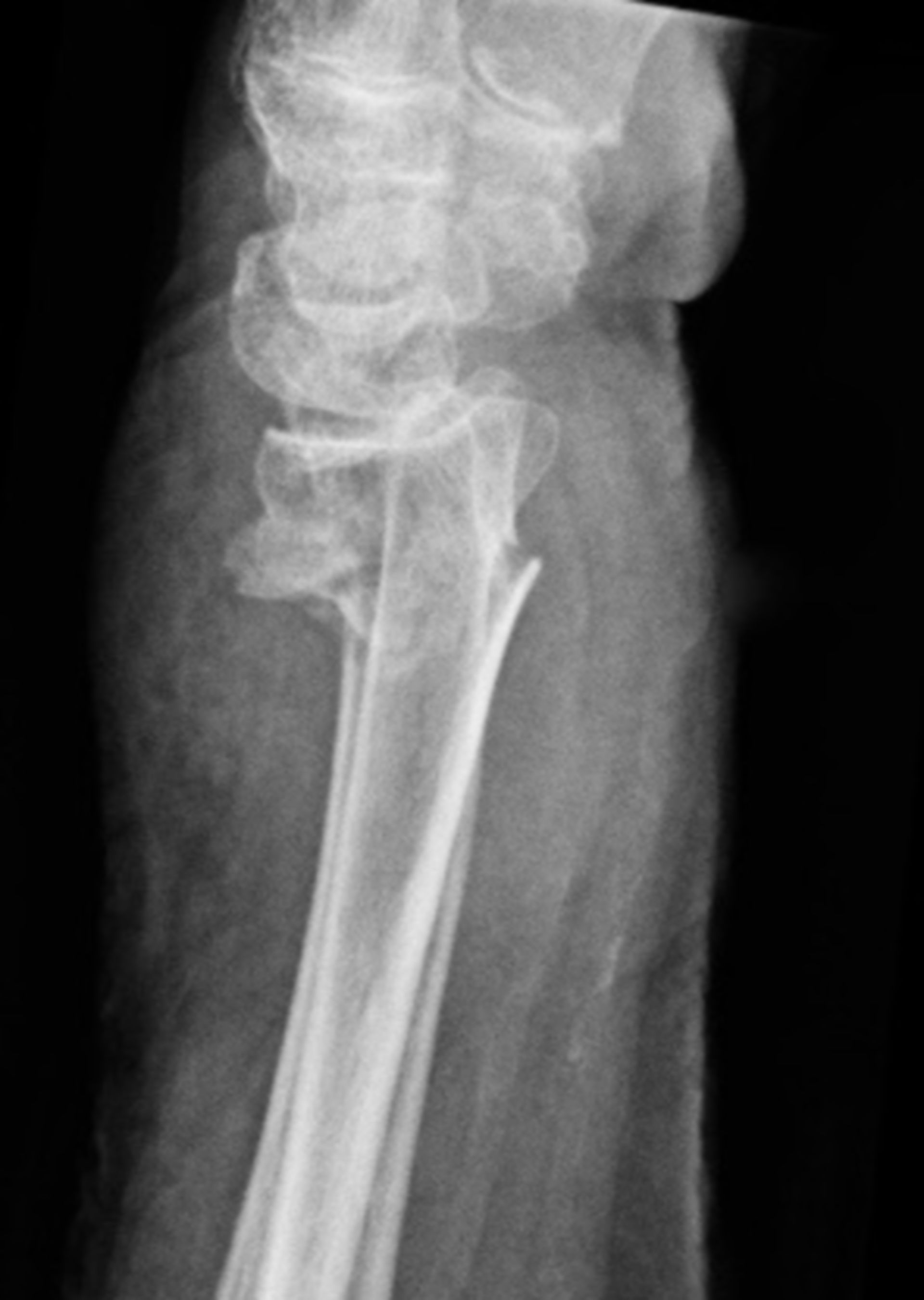 Röntgen des Handgelenkes mit distaler Radiusfraktur und resultierender Nervenkompression