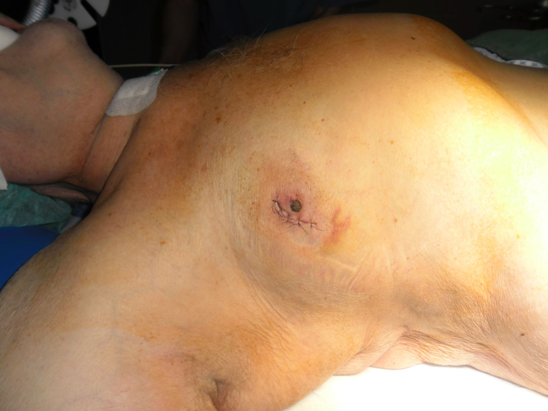 Male patient with breast cancer
