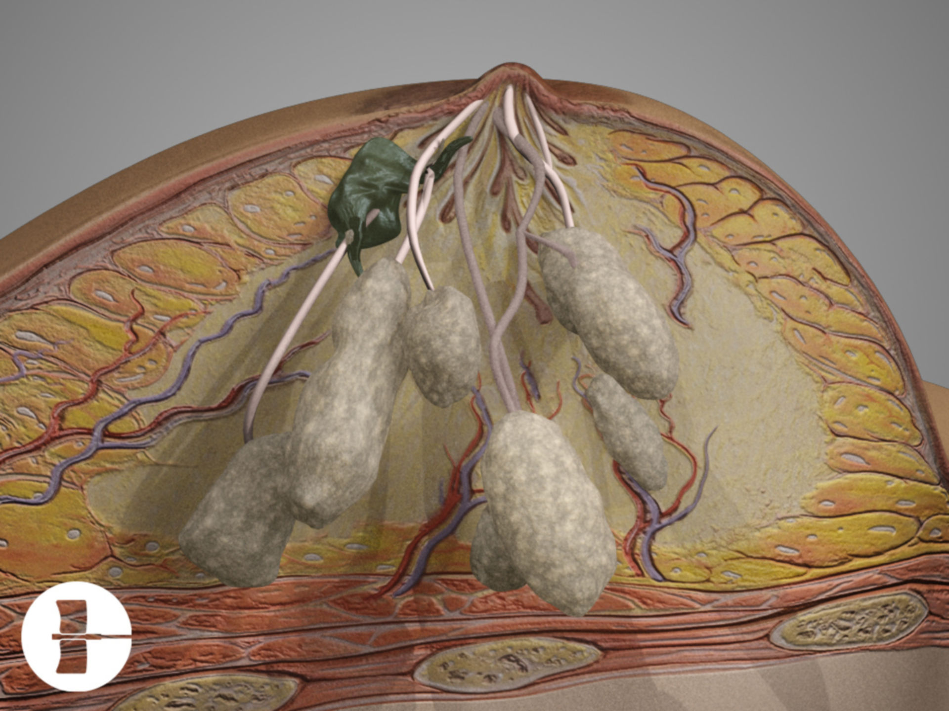 Breast cancer - longitudinal section