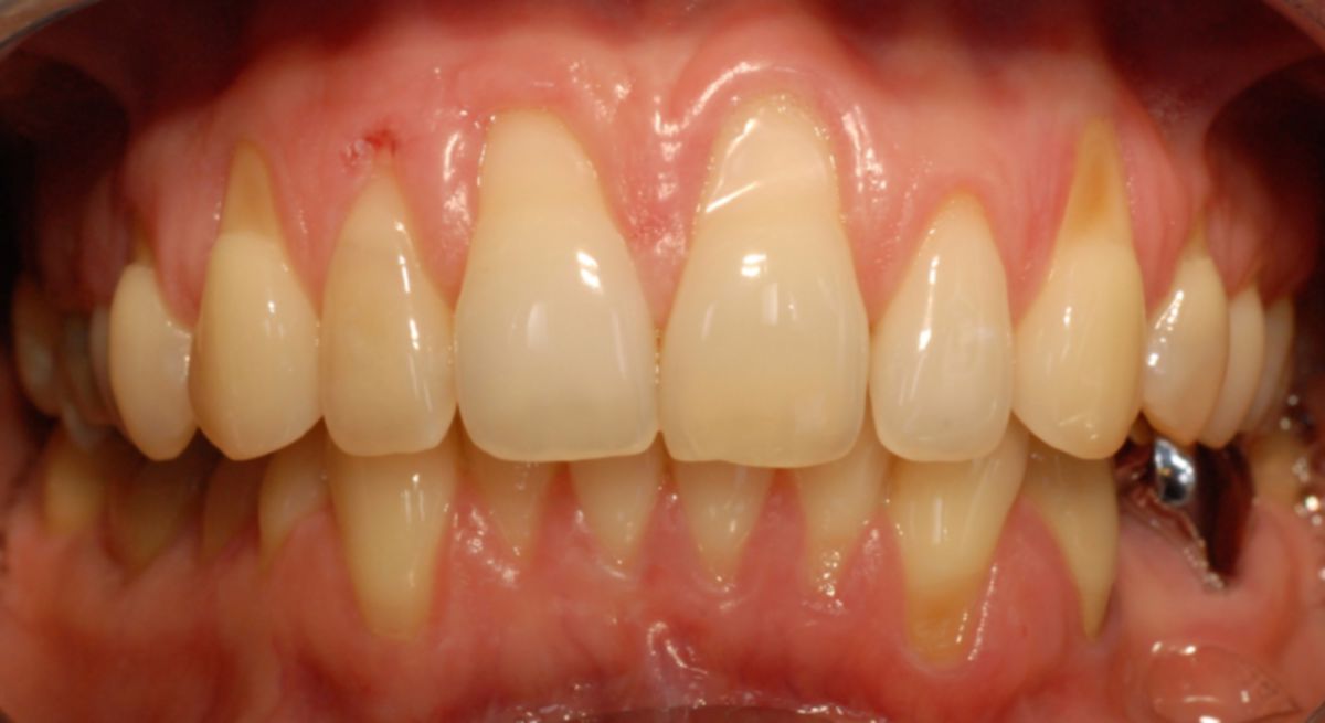Erosionen Zahnfleischretraktion Frontzähne