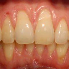 Erosion - DocCheck Flexikon