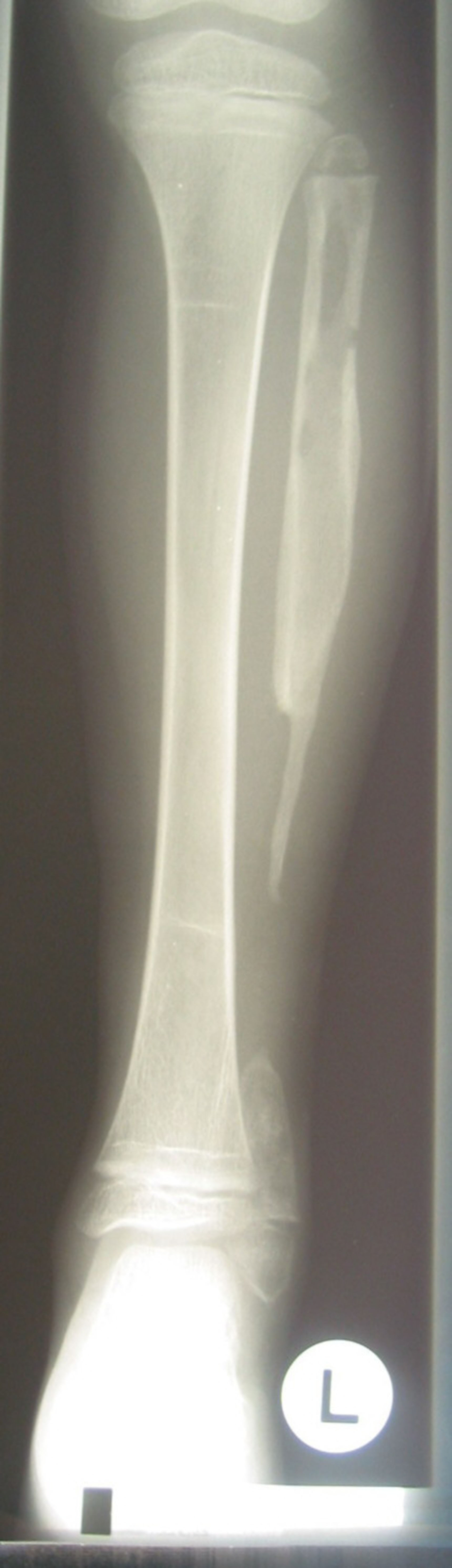 Chronic osteomyelitis of lower leg