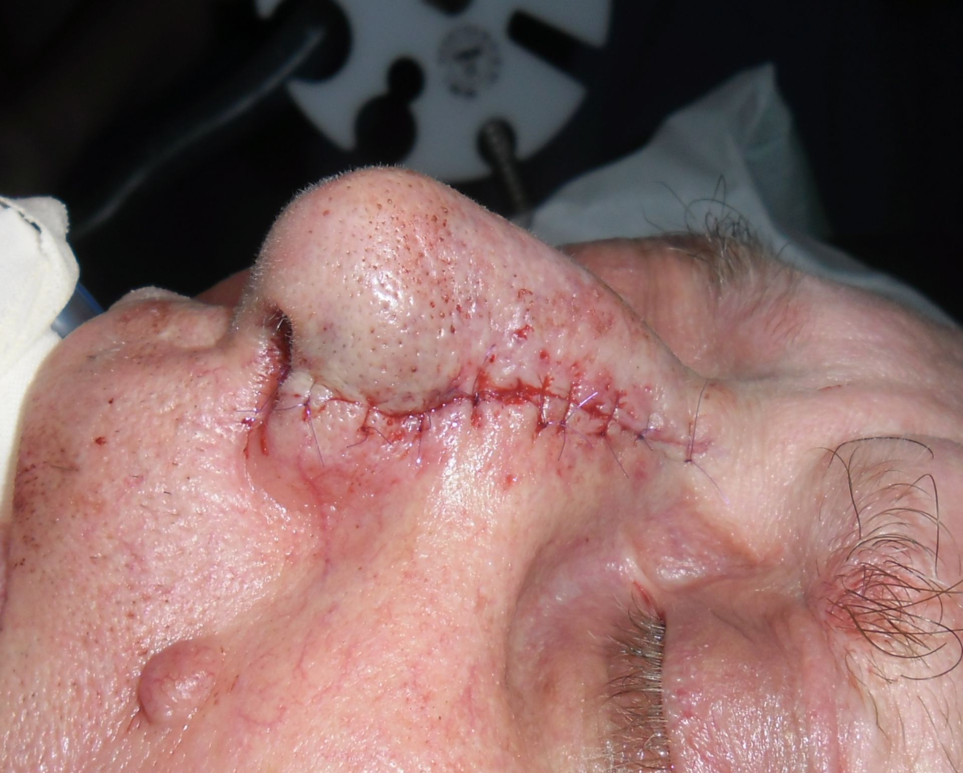 Basal-cell carcinoma - postoperative result