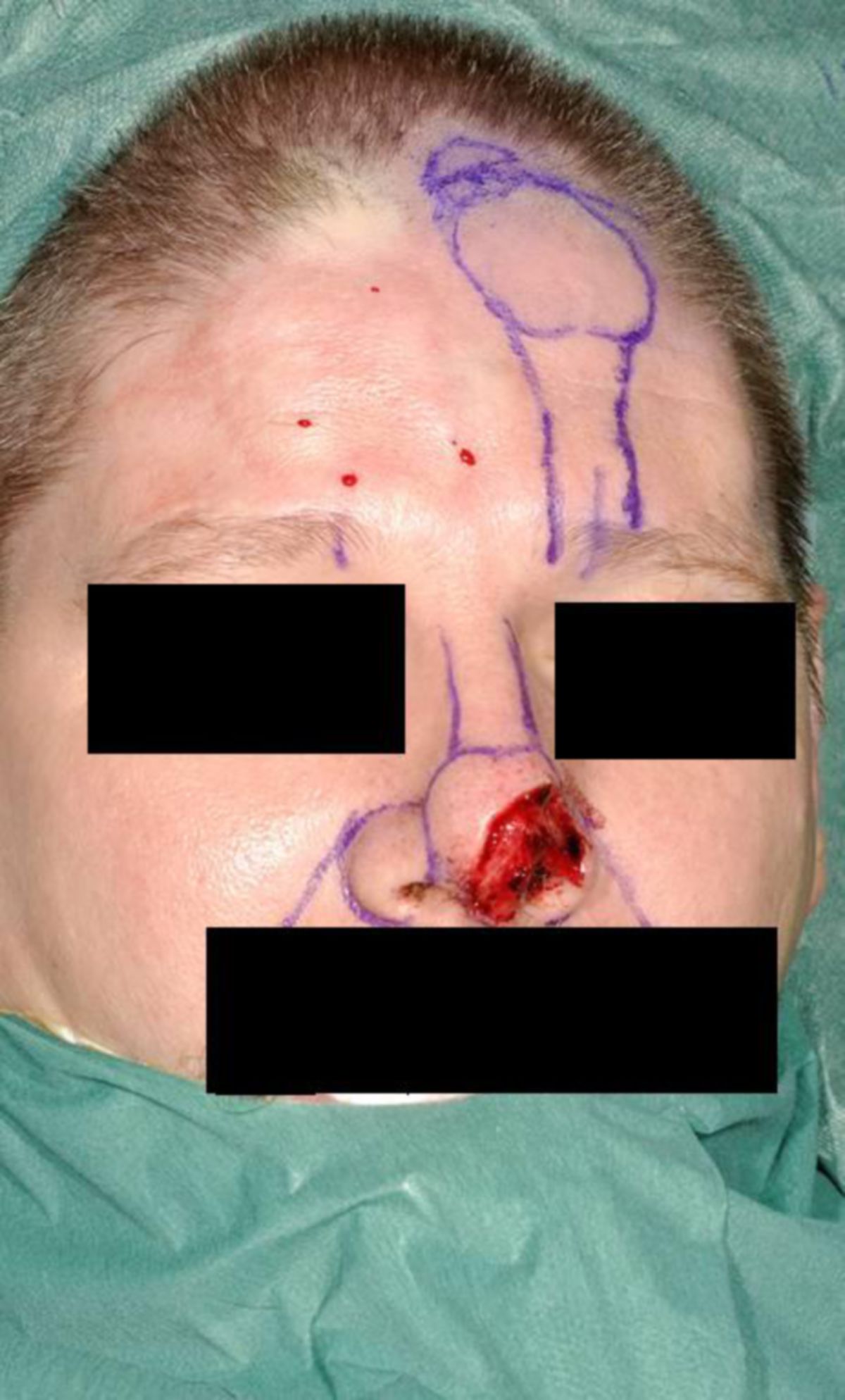 Nasenrekonstruktion mit Vollhauttransplantat aus Stirnlappen (1)