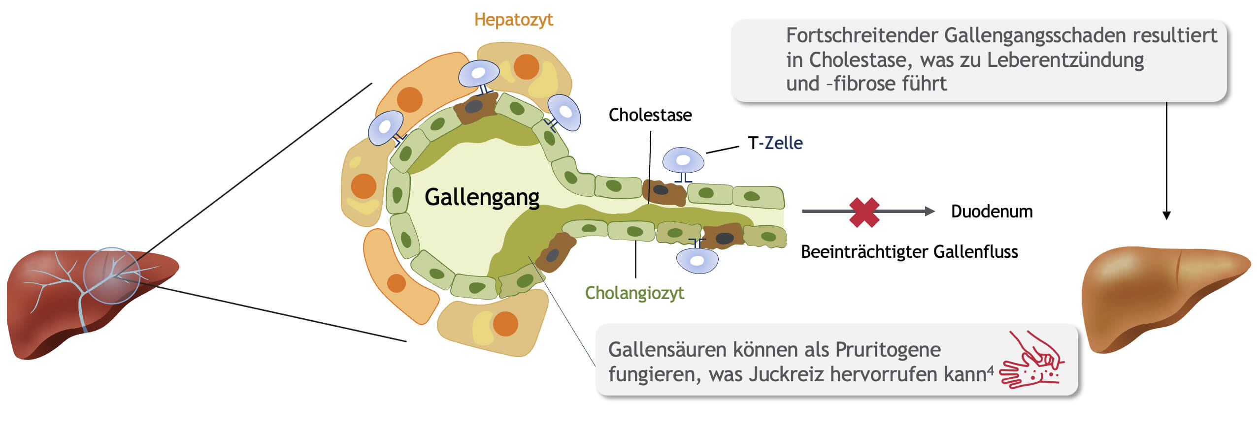 hepioneers_abbildung_pbc_pathogenese_original.jpg