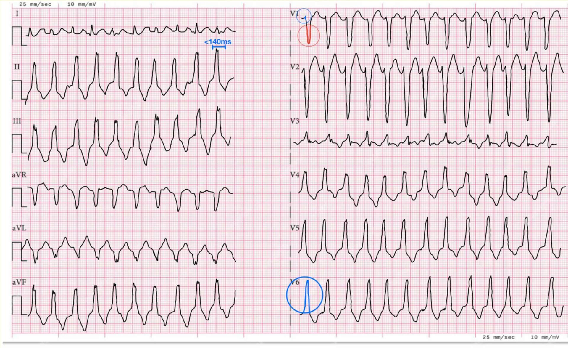 Rechtsventrikuläre Ausflusstrakttachykardie