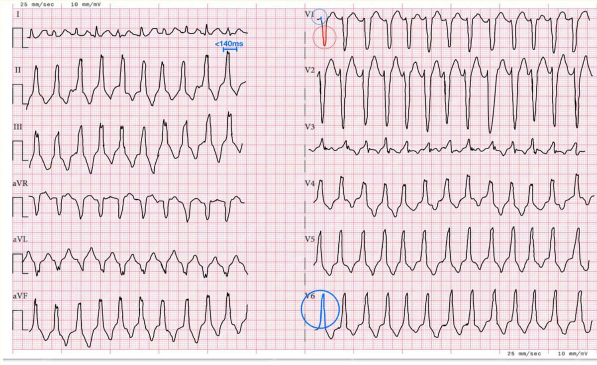 Rechtsventrikuläre Ausflusstrakttachykardie