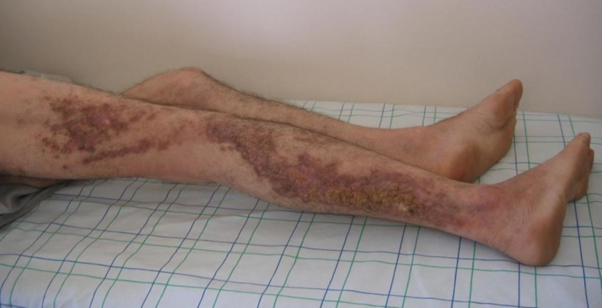 Darier's disease