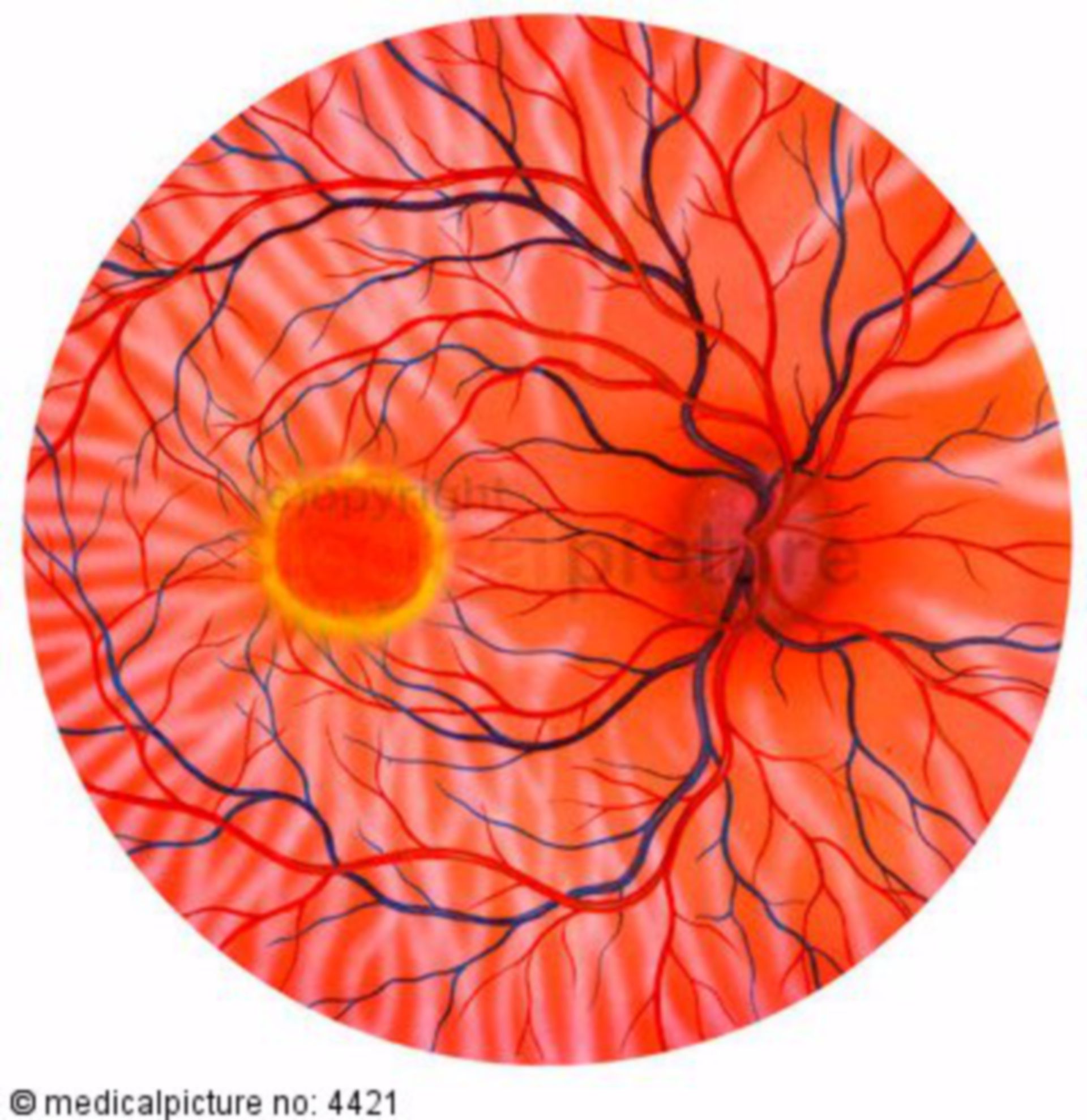 Fundus of the eye with retinopathy (illustration)