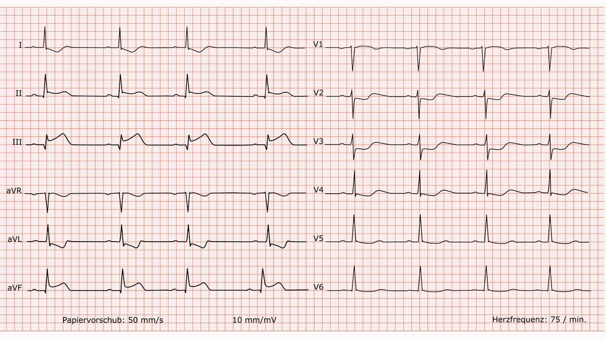 12-Kanal-EKG bei Hinterwandinfarkt