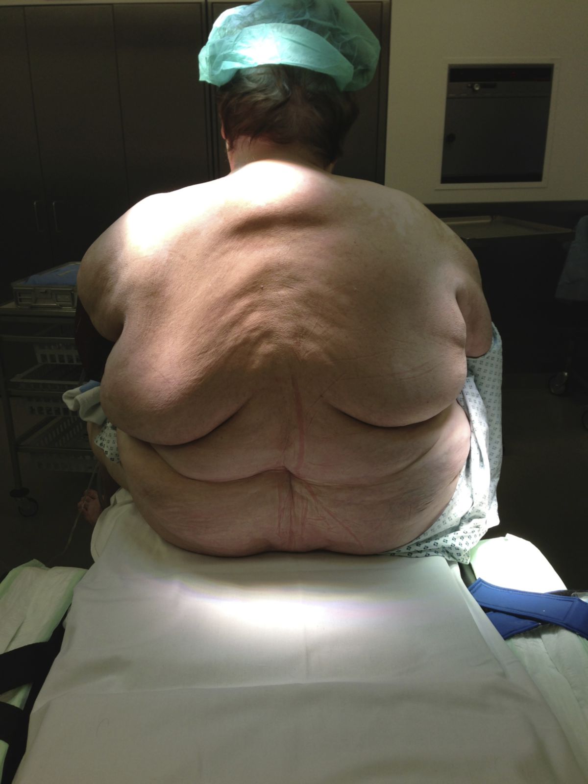 Patientin mit Adipositas per magna mit Fettschürzen am Rücken