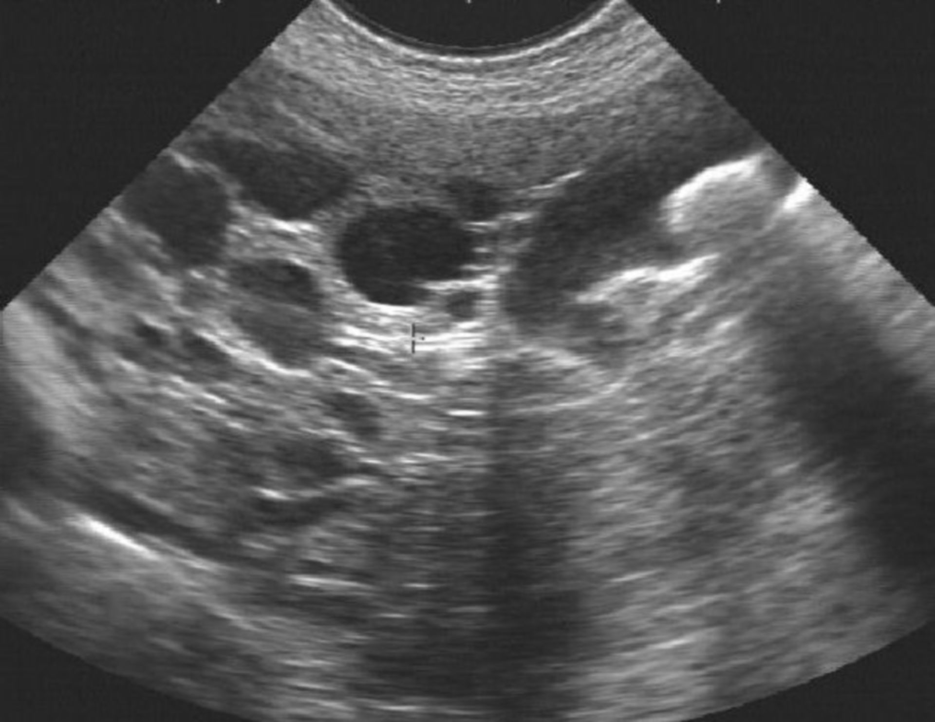 Patient with mltiple liver cysts and gallstones